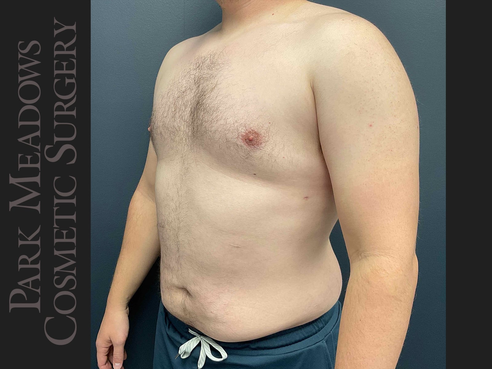 After Image: Gynecomastia (direct excision and liposuction); liposuction of abdomen and flanks - left-front-oblique