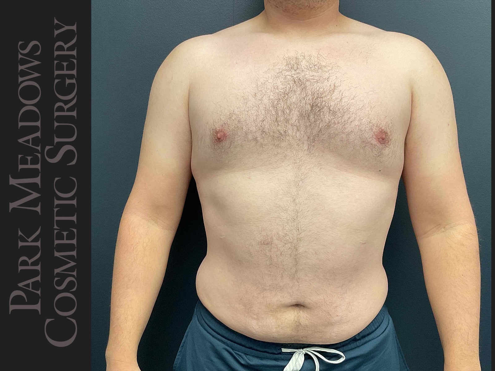Gynecomastia (direct excision and liposuction); liposuction of abdomen and flanks