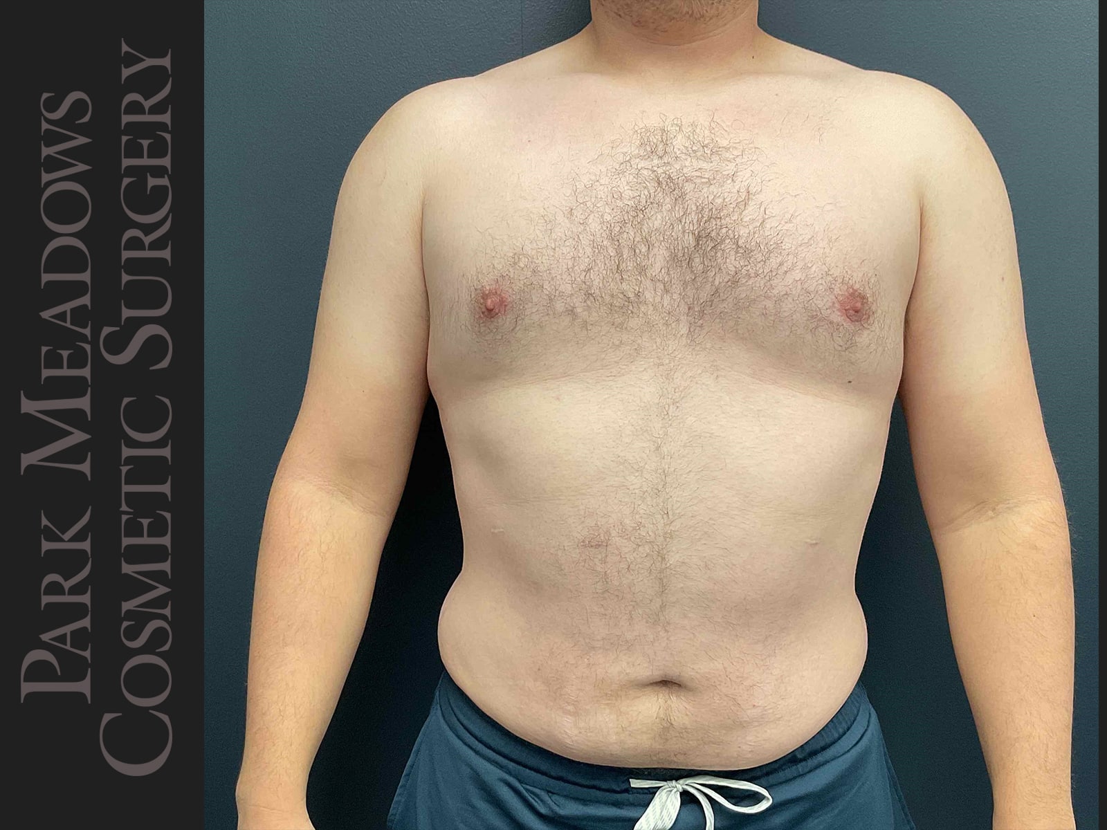 After Image: Gynecomastia (direct excision and liposuction); liposuction of abdomen and flanks - front