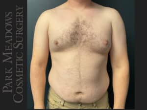 Gynecomastia (direct excision and liposuction); liposuction of abdomen and flanks