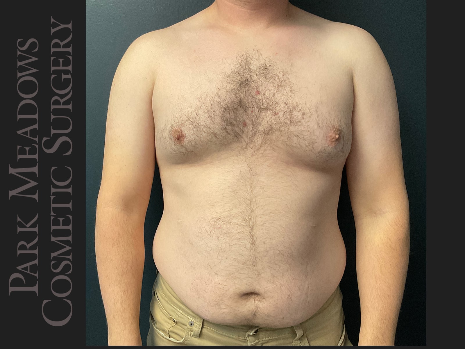 Before Image: Gynecomastia (direct excision and liposuction); liposuction of abdomen and flanks - front