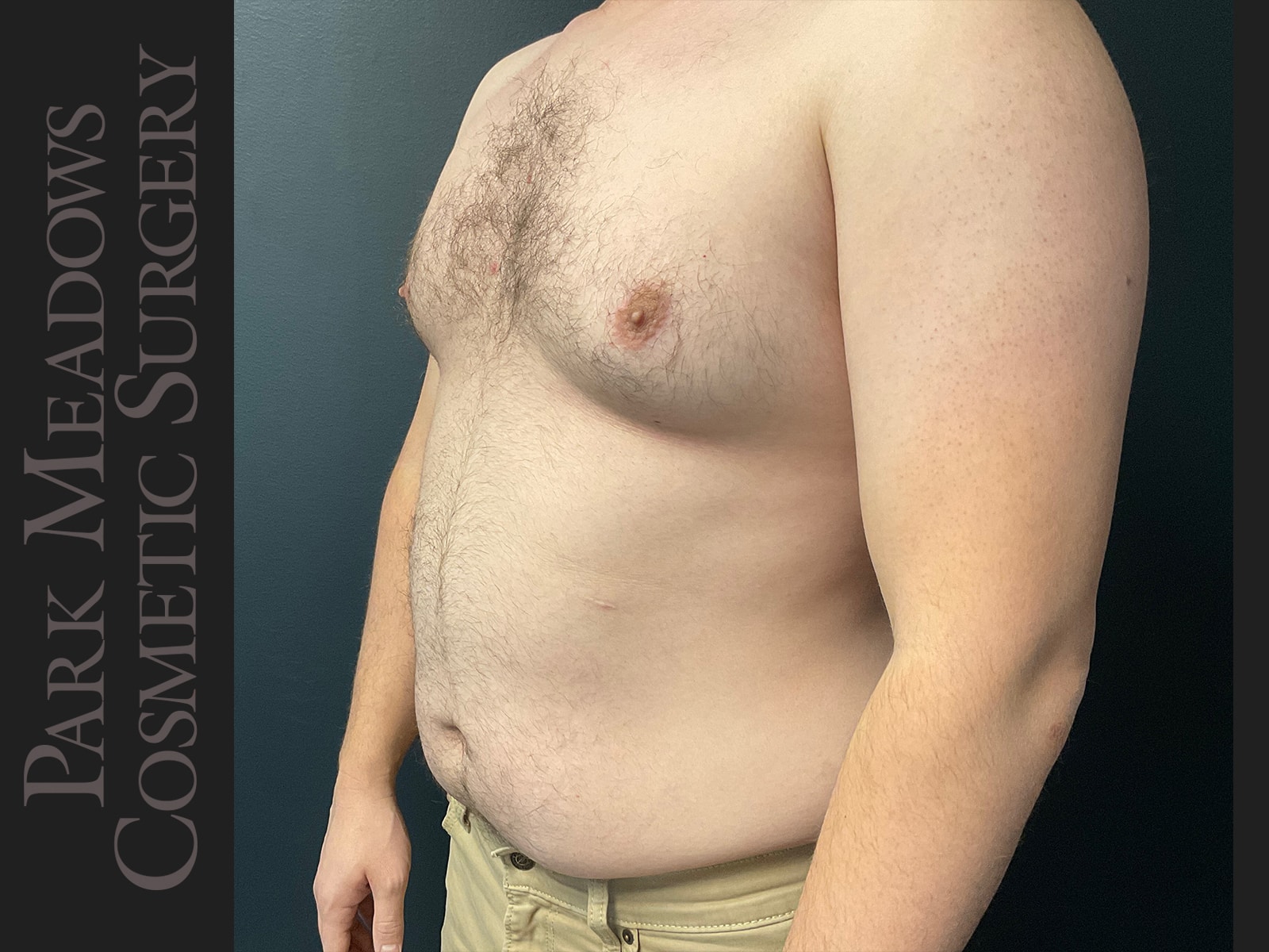 Before Image: Gynecomastia (direct excision and liposuction); liposuction of abdomen and flanks - left-front-oblique