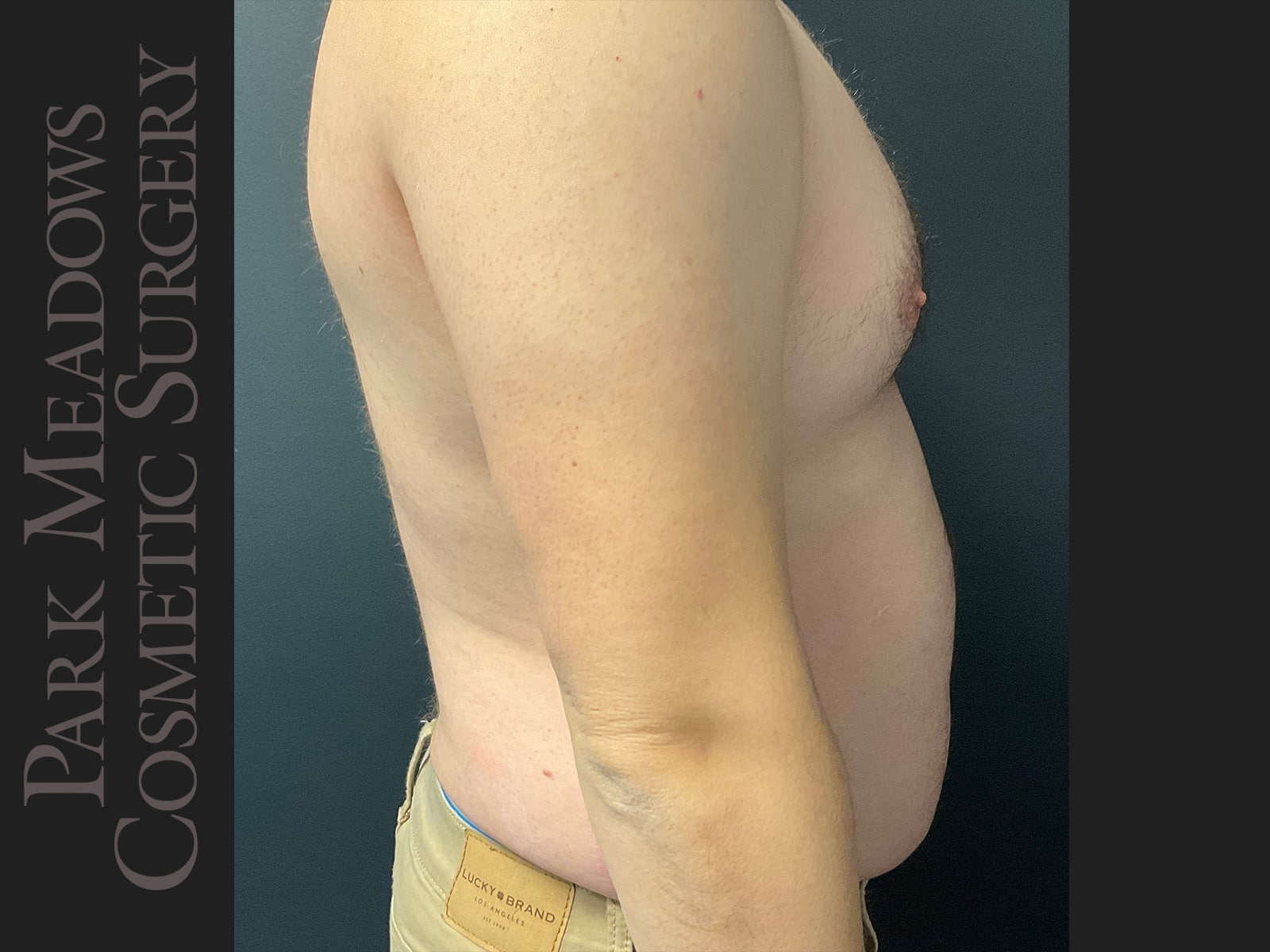 Before Image: Gynecomastia (direct excision and liposuction); liposuction of abdomen and flanks - right-side