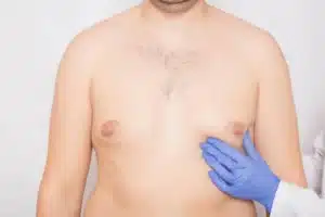 male breast reduction