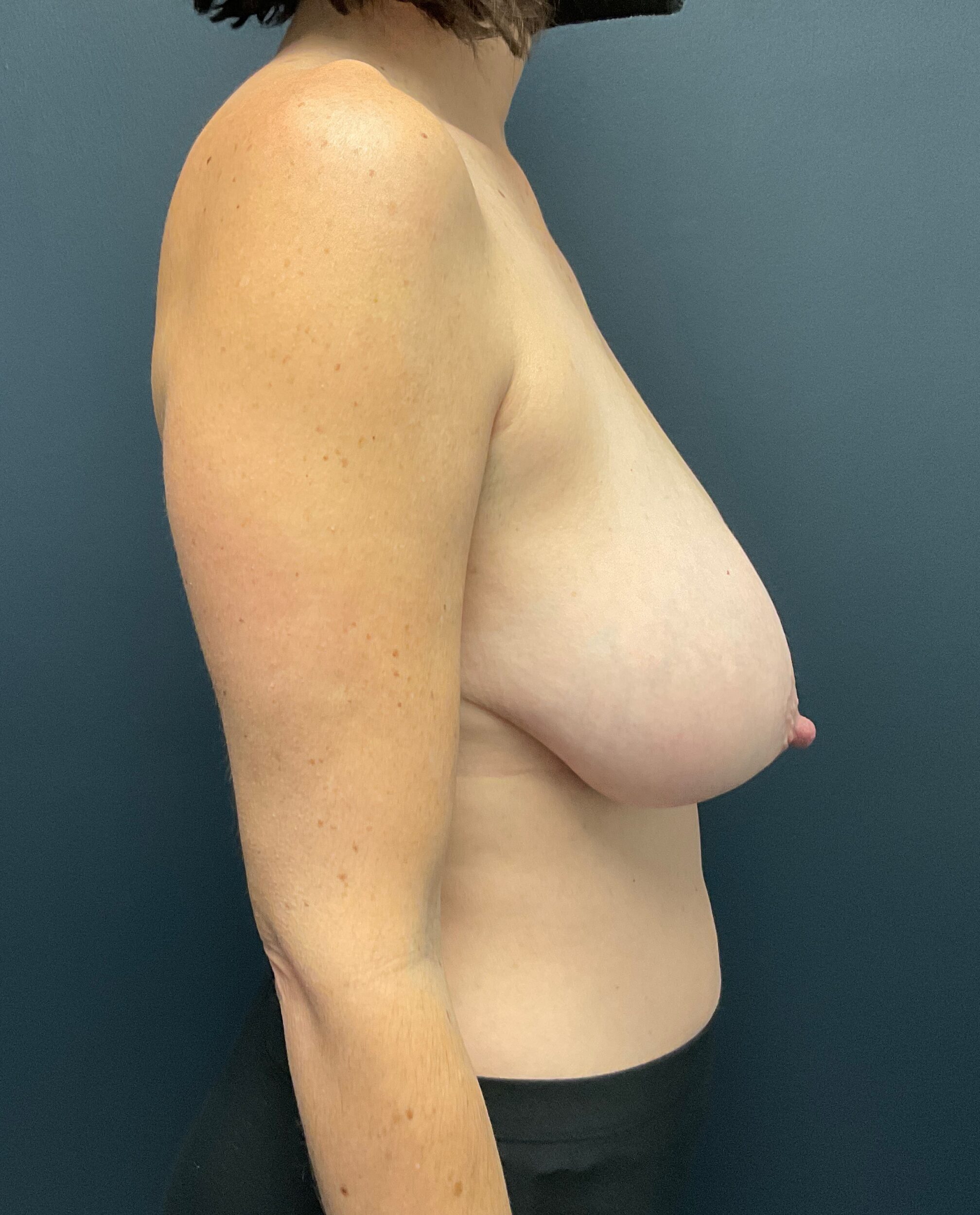 Before Image: Cosmetic Breast Reduction; 4 months postoperative - right-side