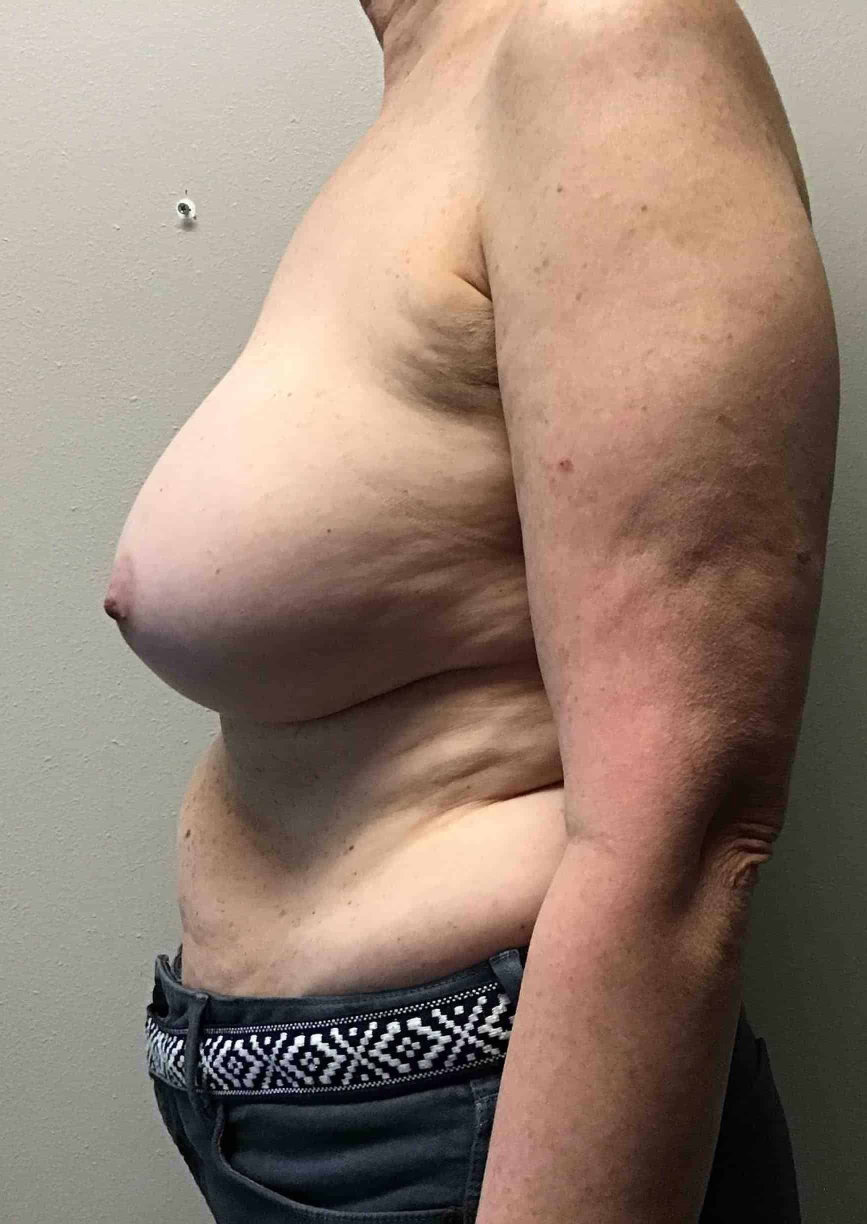 Before Image: Bilateral Total Capsulectomy with Breast Implant Removal; 5 months postoperative - left-side
