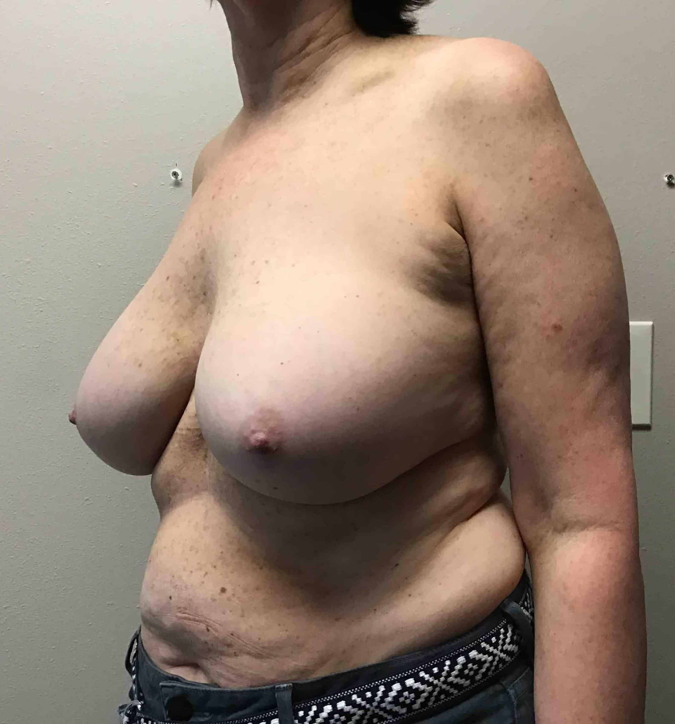 Before Image: Bilateral Total Capsulectomy with Breast Implant Removal; 5 months postoperative - left-front-oblique