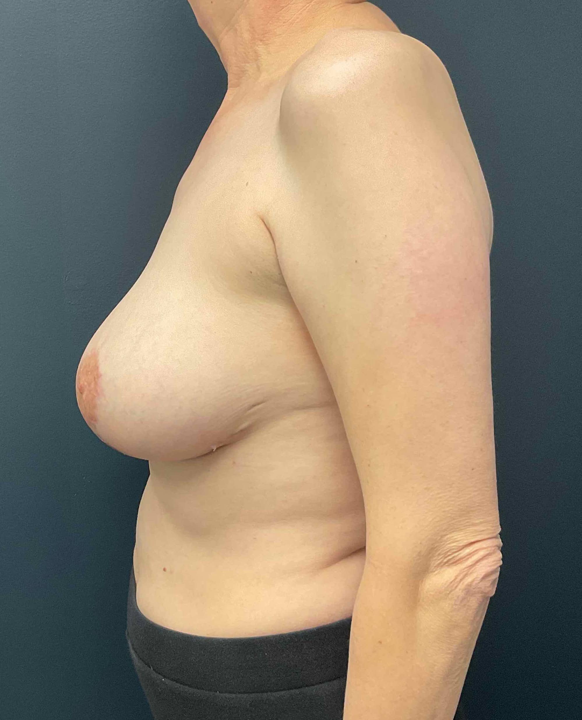 After Image: Breast Lift with 250cc Silicone Implants; 4 months postoperative - left-side