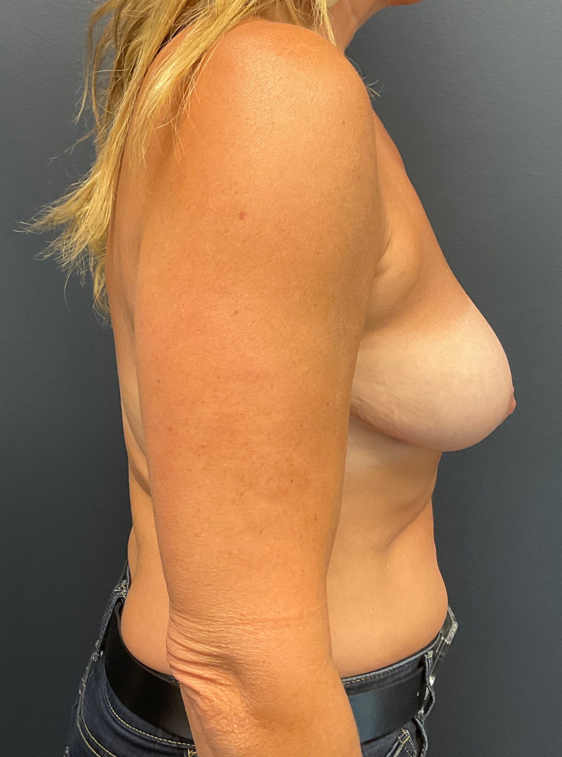 After Image: Breast Implant Removal; Mastopexy (breast lift); 6 months postoperative - right-side