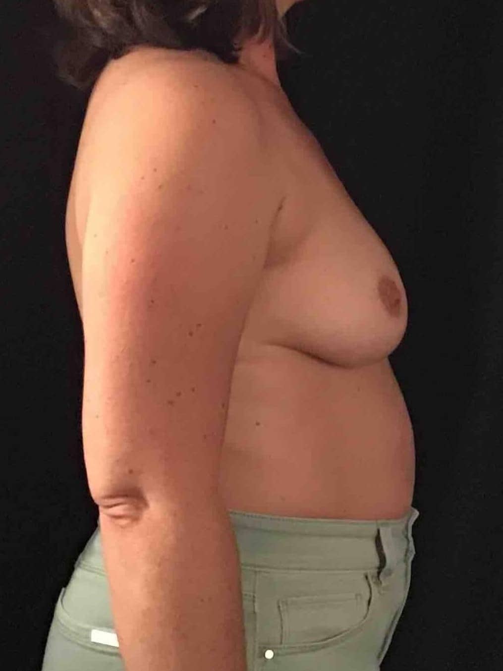 Before Image: Breast Lift with 250cc Silicone Implants; 4 months postoperative - right-side