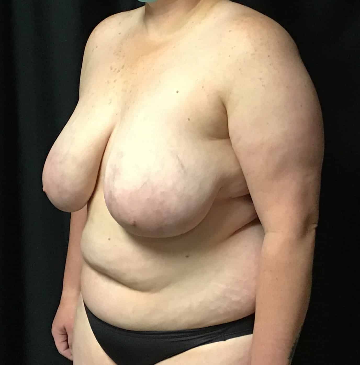 Before Image: Cosmetic Breast Reduction; 3 months postoperative - left-front-oblique