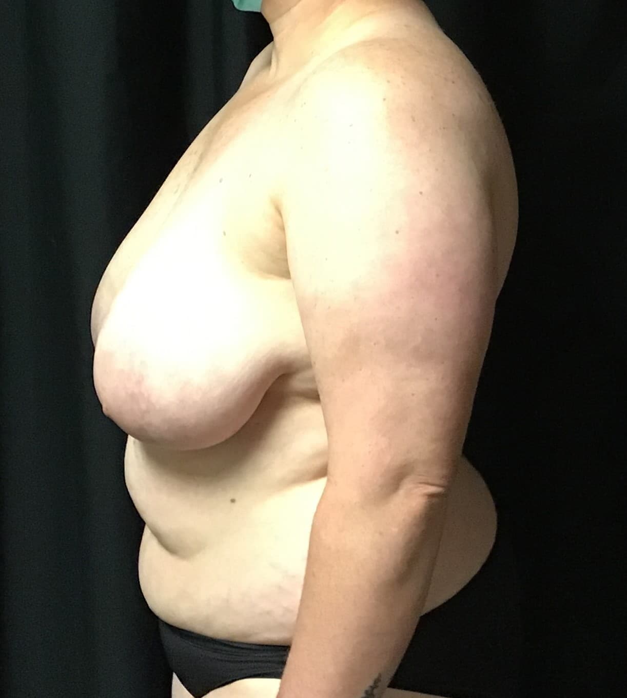 Before Image: Cosmetic Breast Reduction; 3 months postoperative - left-side