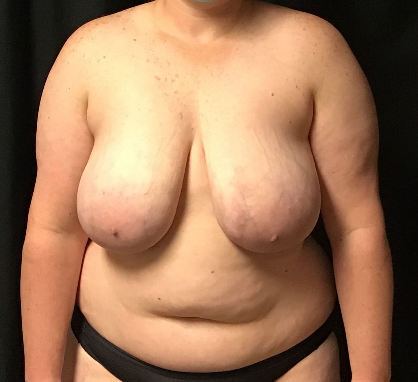 Before Image: Cosmetic Breast Reduction; 3 months postoperative - front
