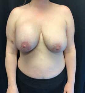 Bilateral En Bloc Capsulectomy with Breast Implant Removal; Mastopexy; 7 months postoperative