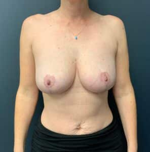 Cosmetic Breast Reduction; 4 months postoperative