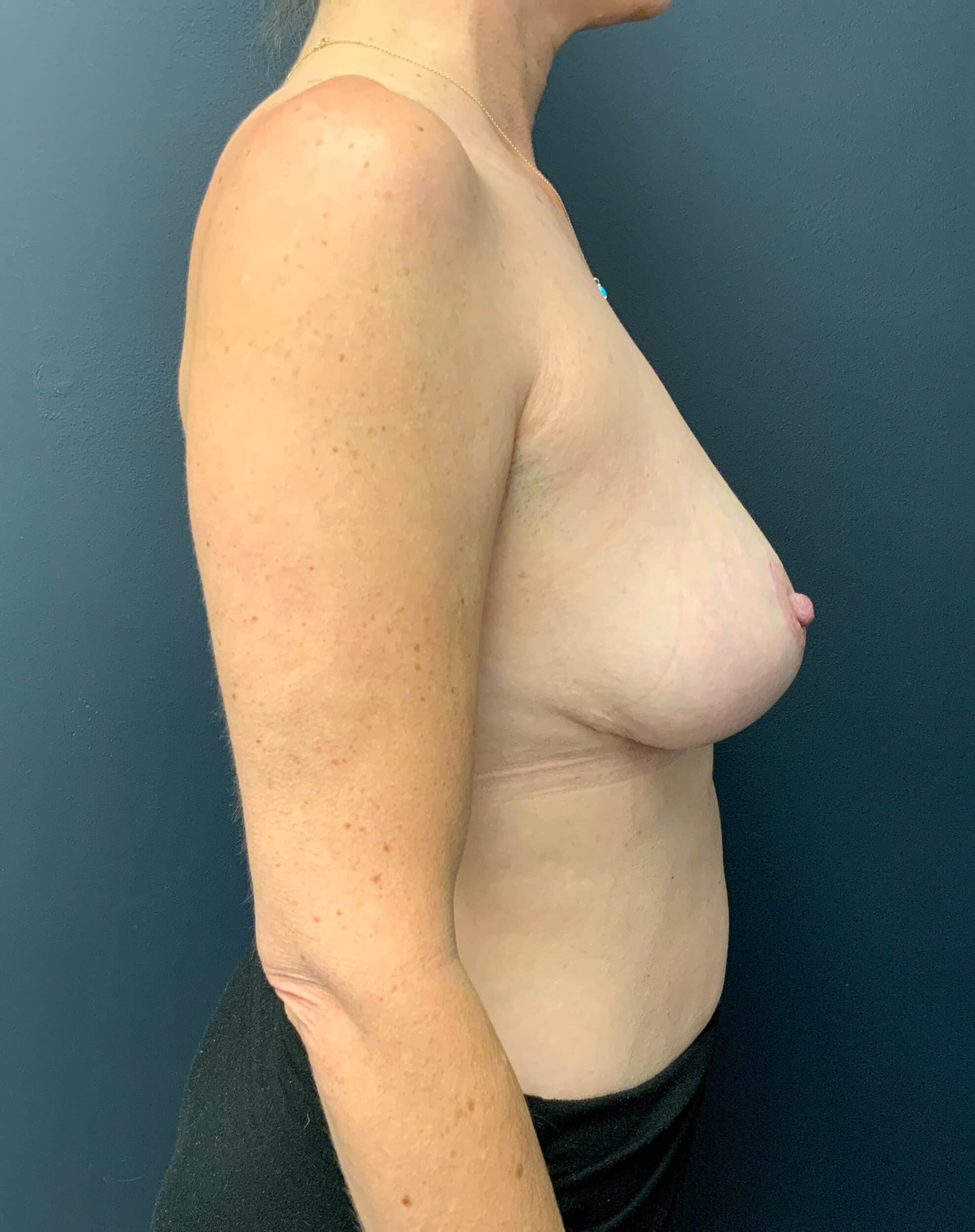 After Image: Cosmetic Breast Reduction; 4 months postoperative - right-side