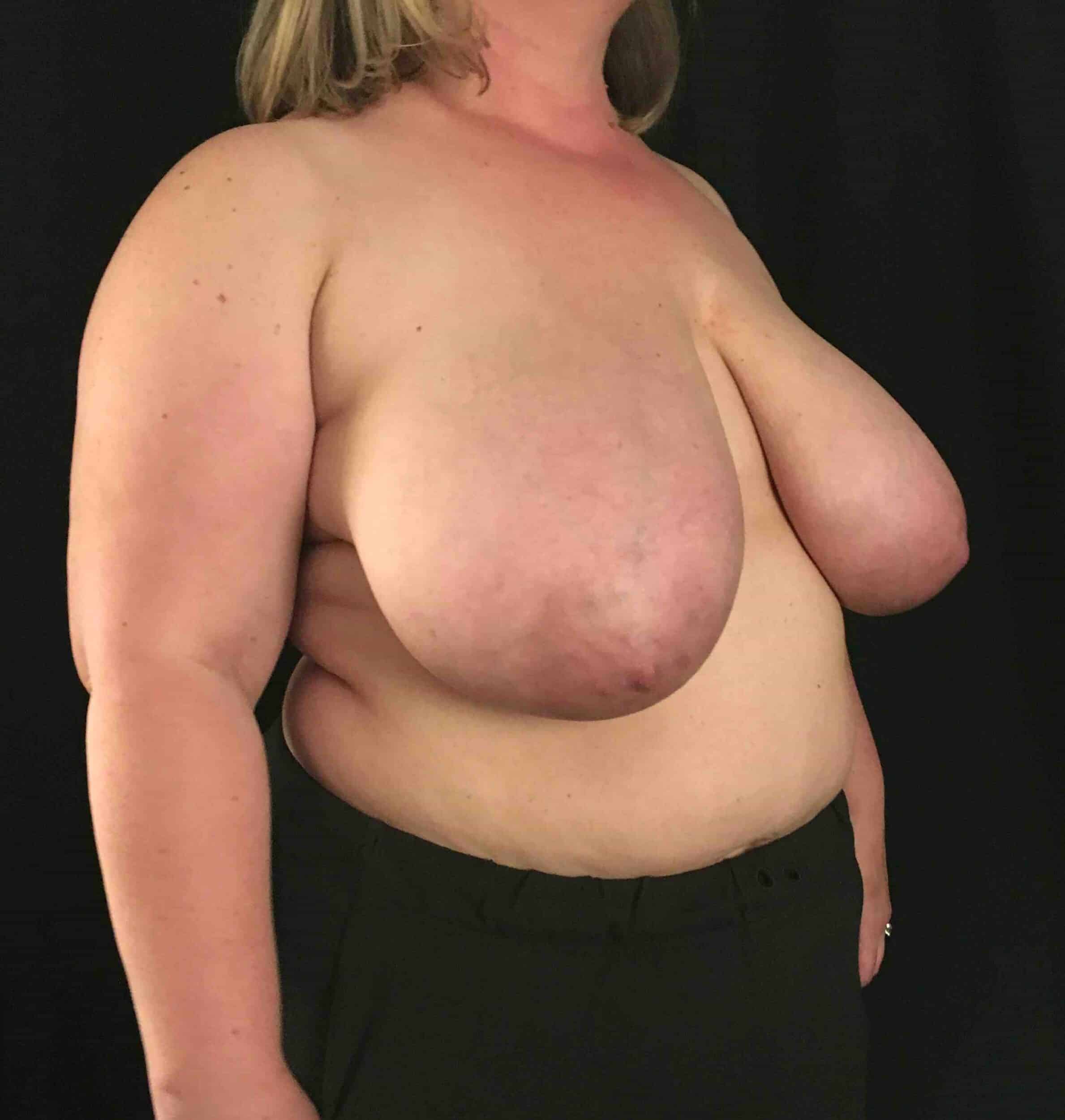 Before Image: Cosmetic Breast Reduction; 6 months postoperative - right-front-oblique