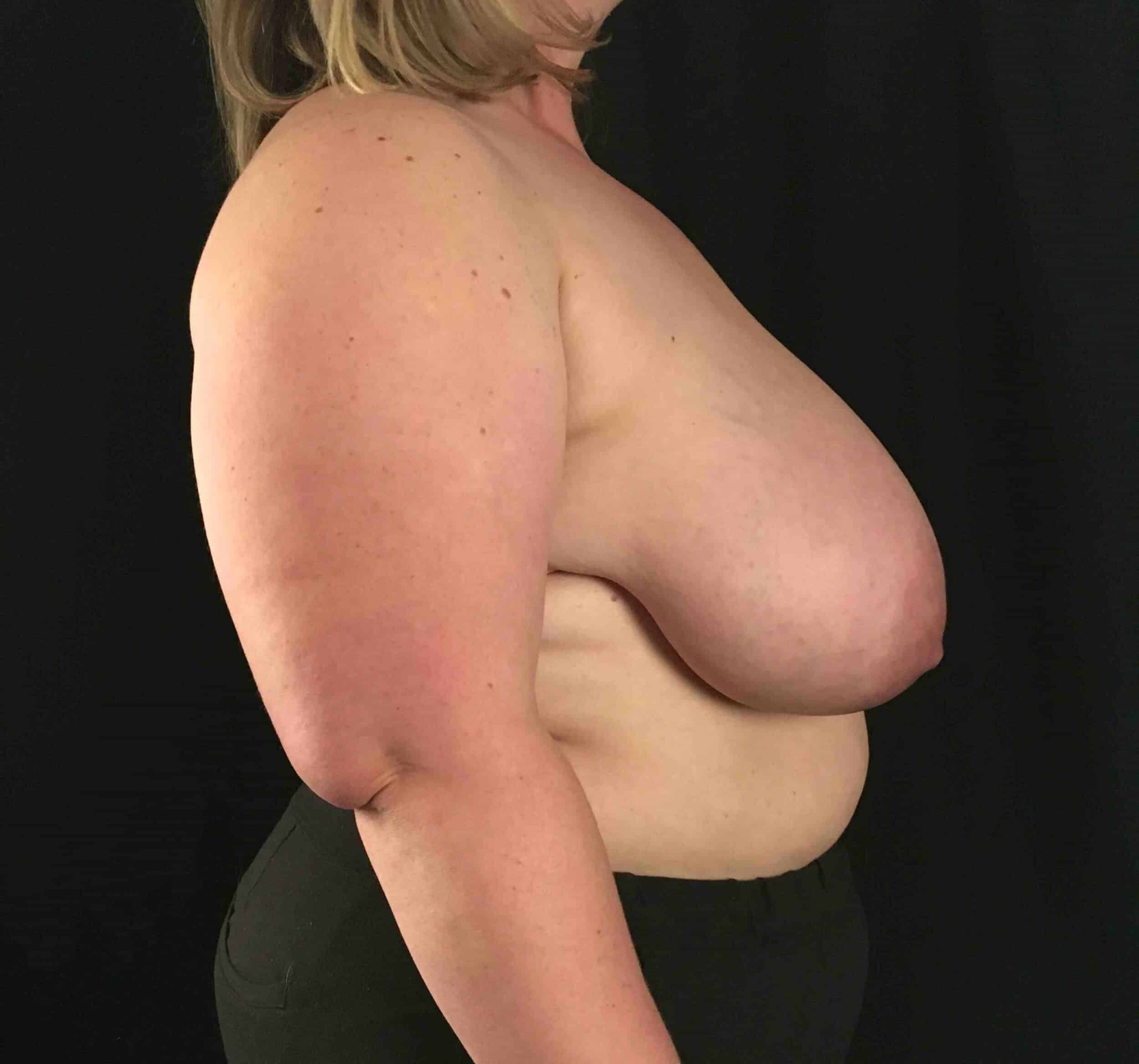 Before Image: Cosmetic Breast Reduction; 6 months postoperative - right-side