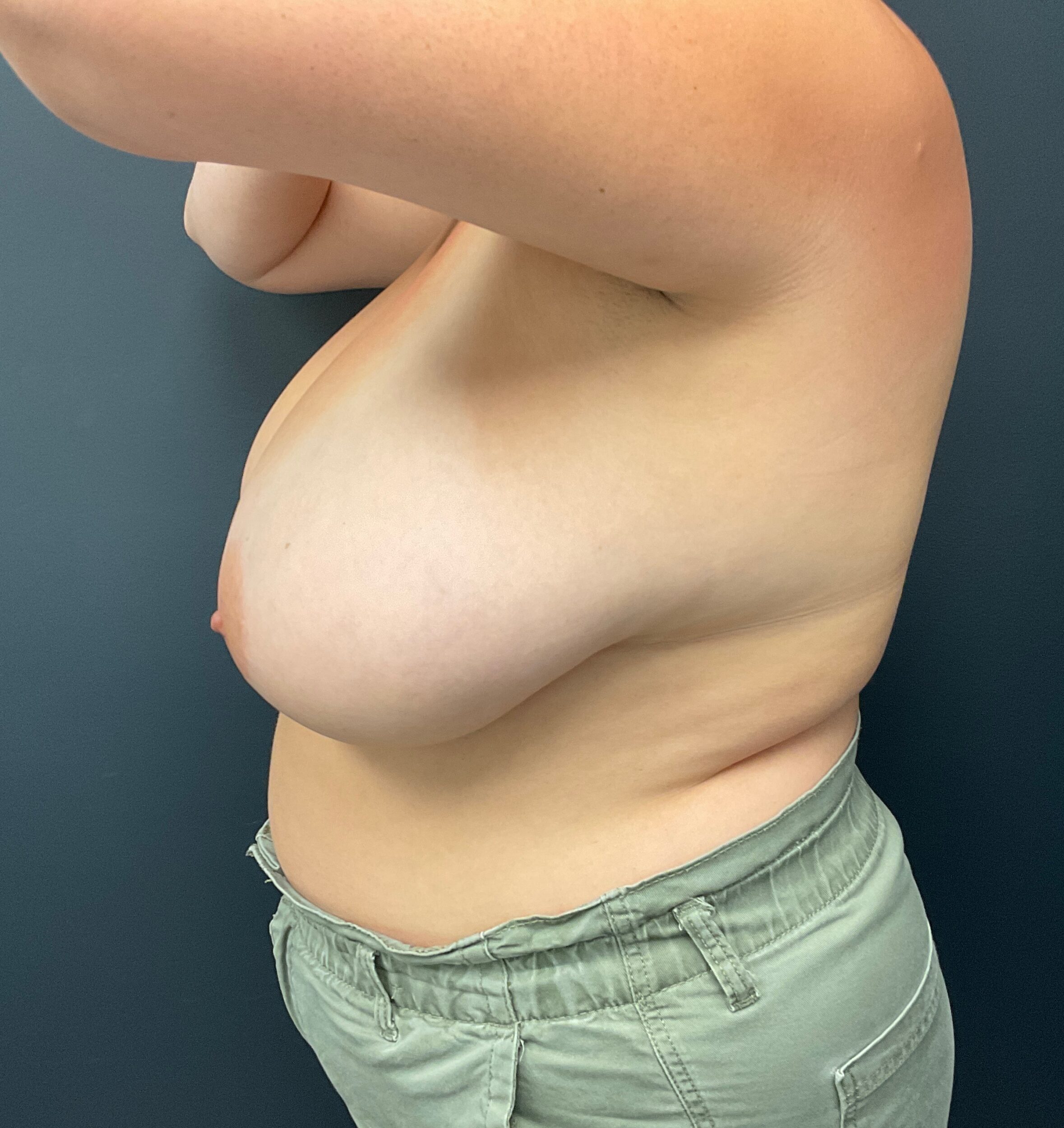 Before Image: Cosmetic Breast Reduction; 5 months postoperative - left-side