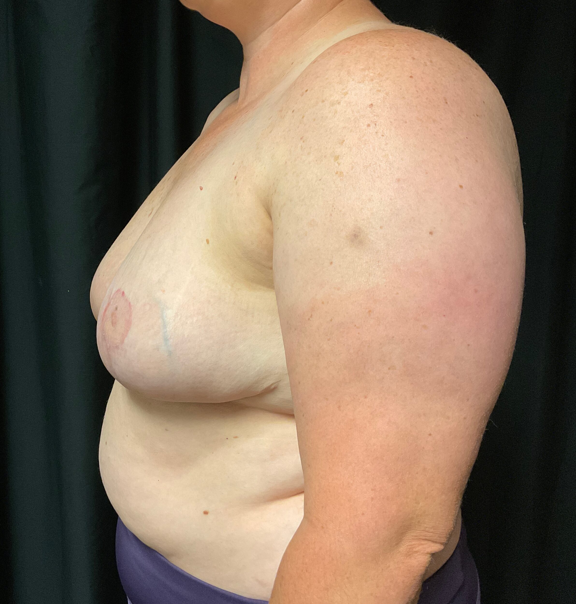 After Image: Cosmetic Breast Reduction; 3 months postoperative - left-side
