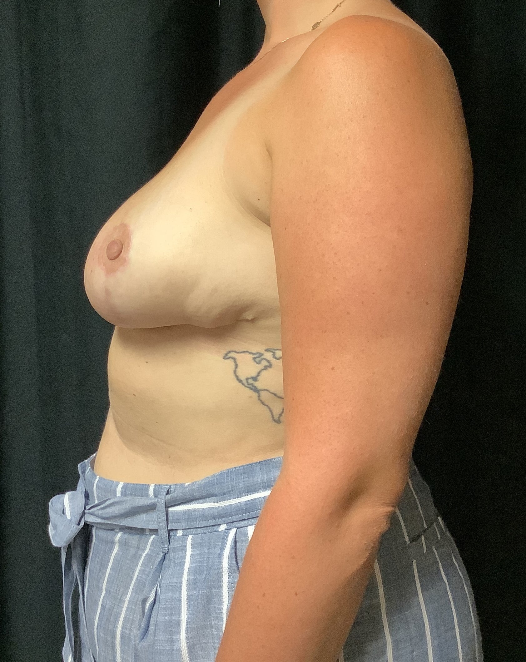 After Image: Cosmetic Breast Reduction; 4 months postoperative - left-side