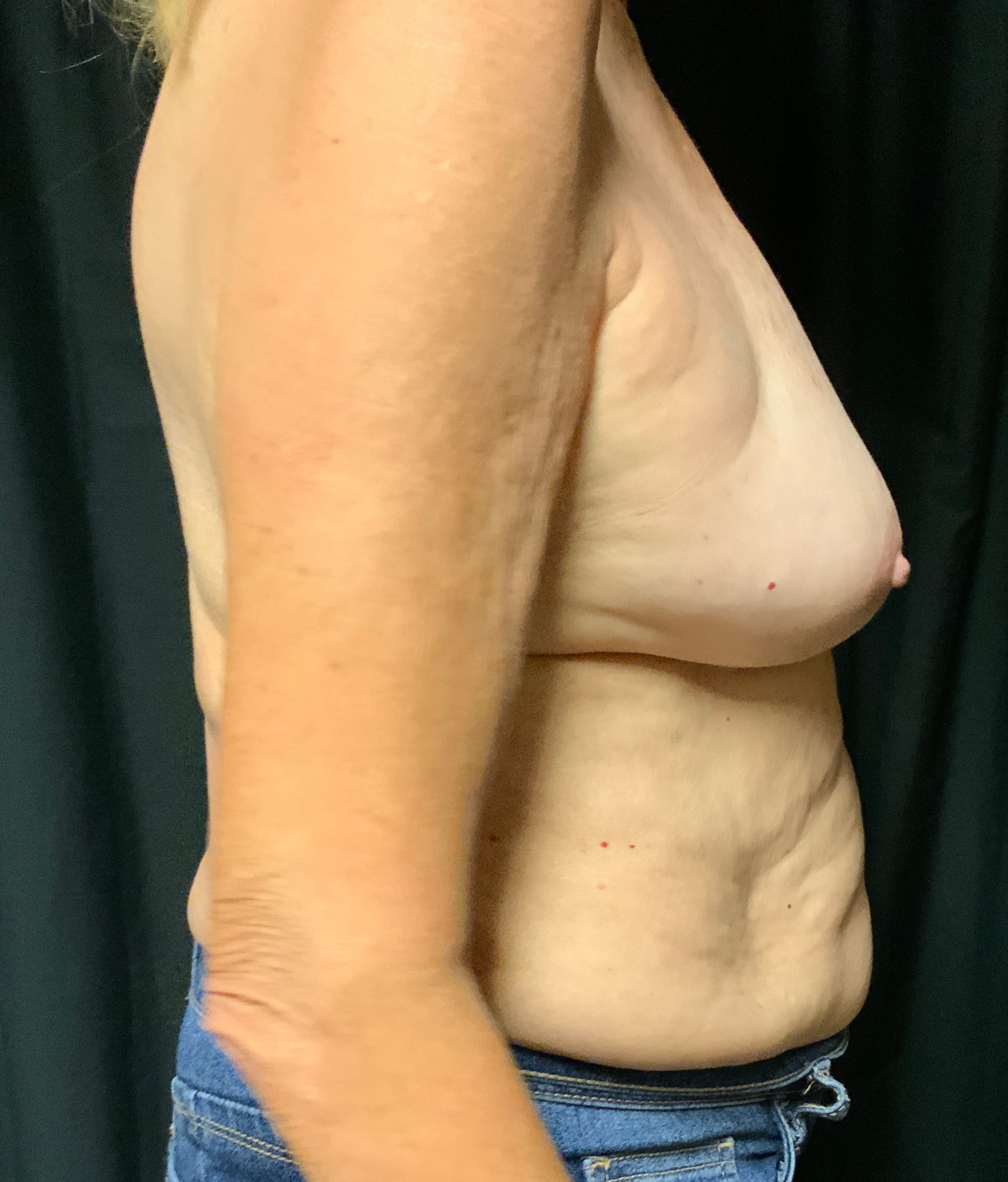 Before Image: Breast Implant Exchange - right-side