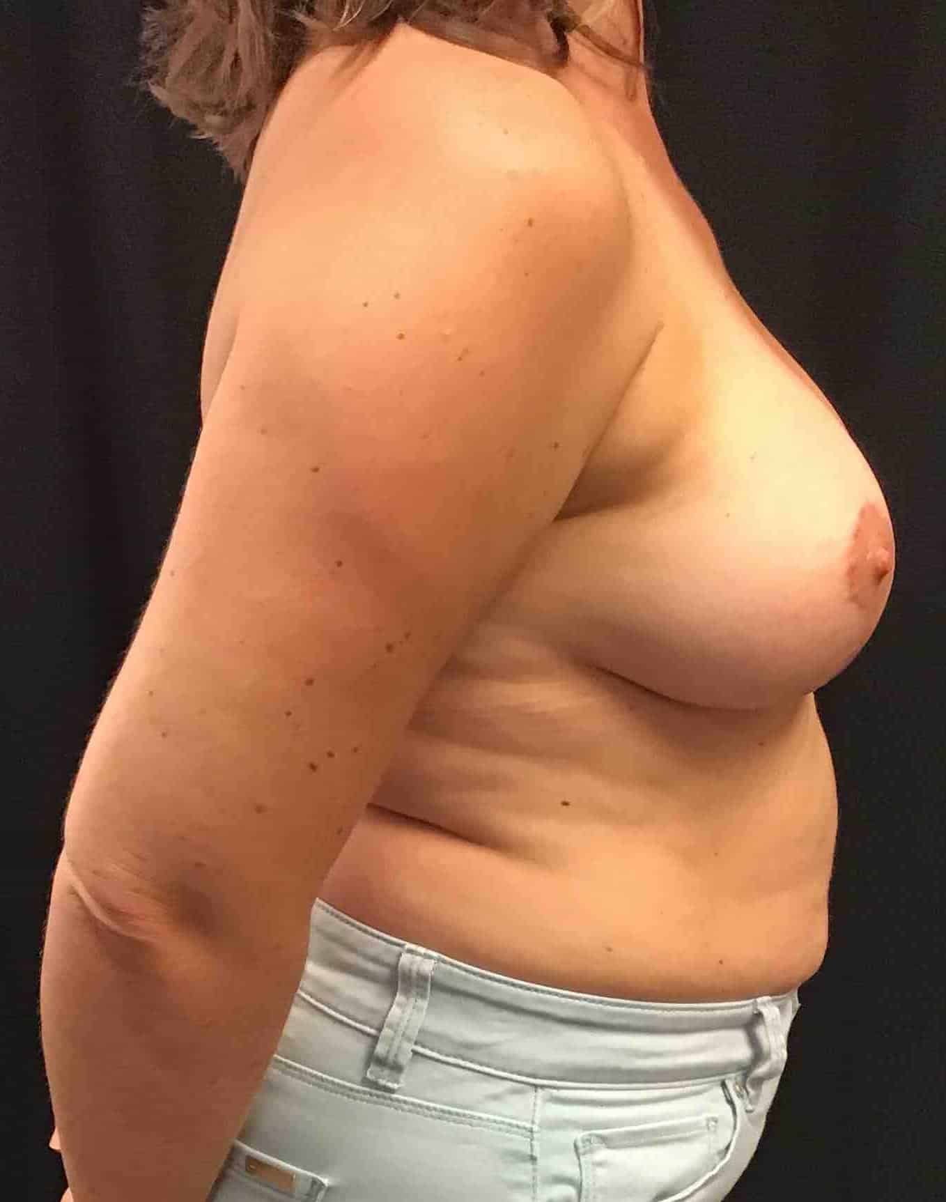 After Image: Breast Lift with 250cc Silicone Implants; 4 months postoperative - right-side