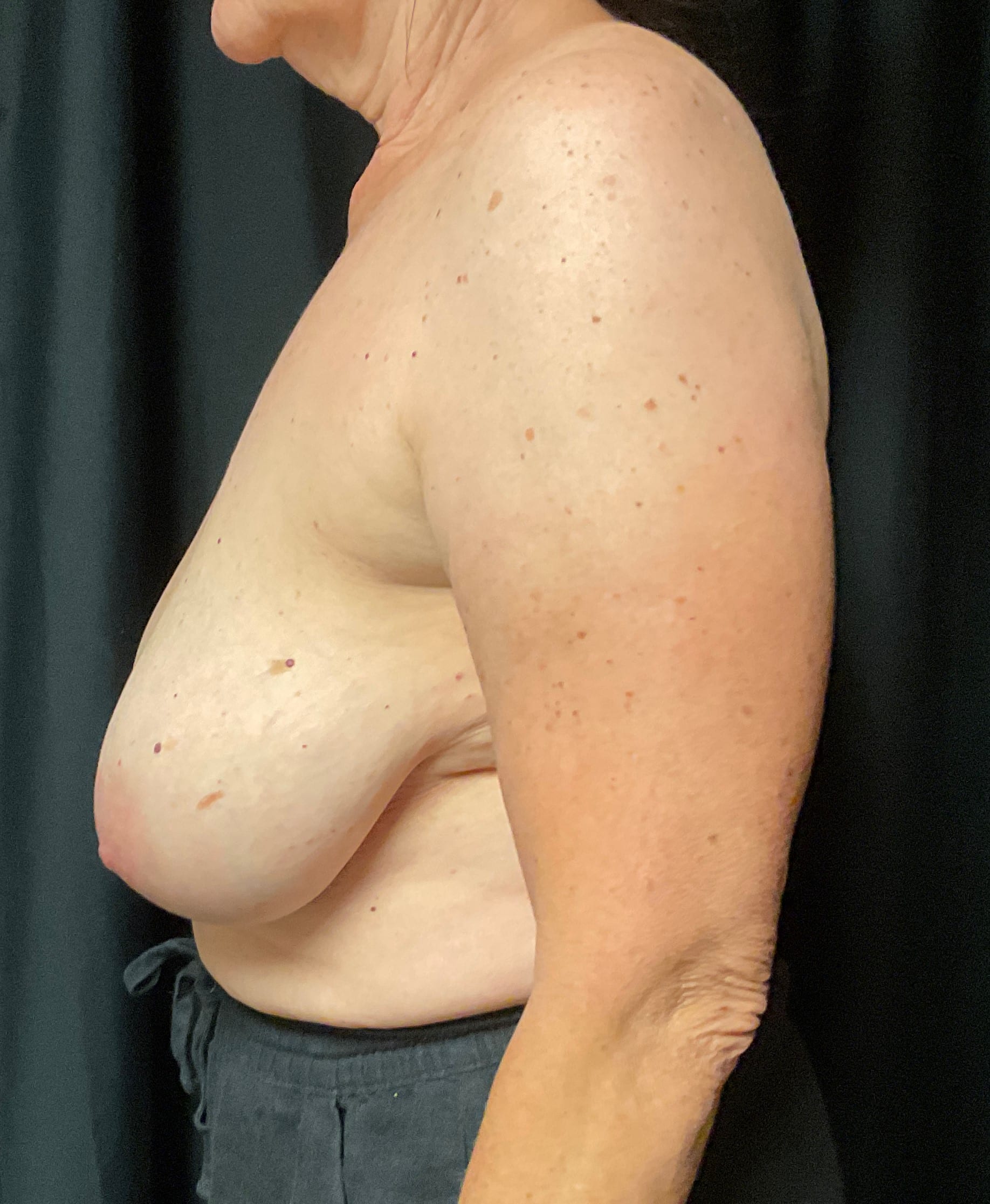 Before Image: Cosmetic Breast Reduction; 4 months postoperative - left-side