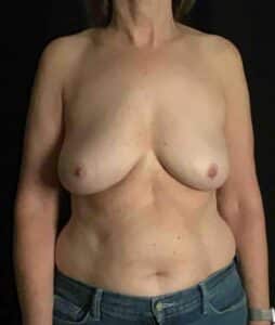 Bilateral Total Capsulectomy with Breast Implant Removal; 5 months postoperative