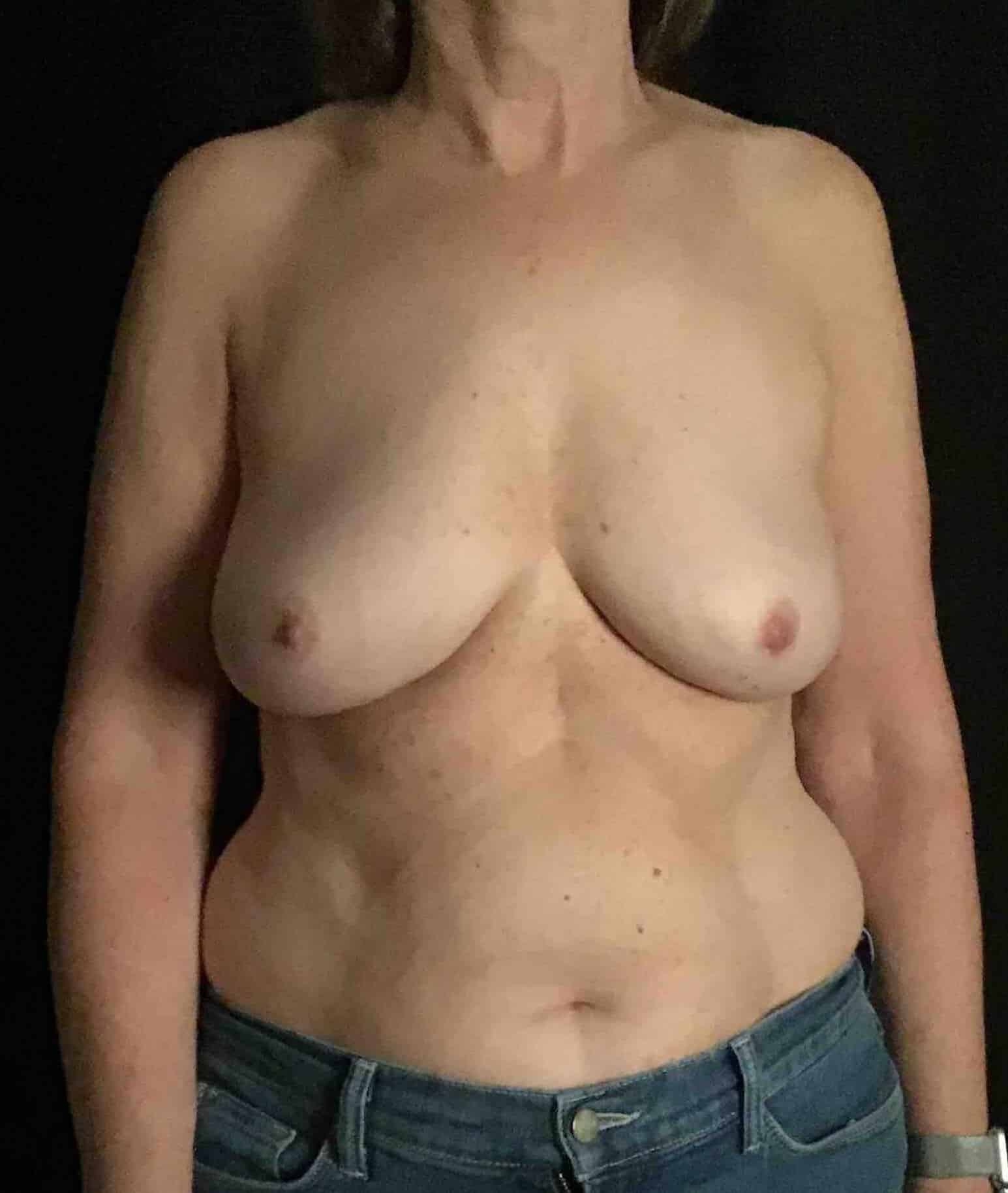 After Image: Bilateral Total Capsulectomy with Breast Implant Removal; 5 months postoperative - front