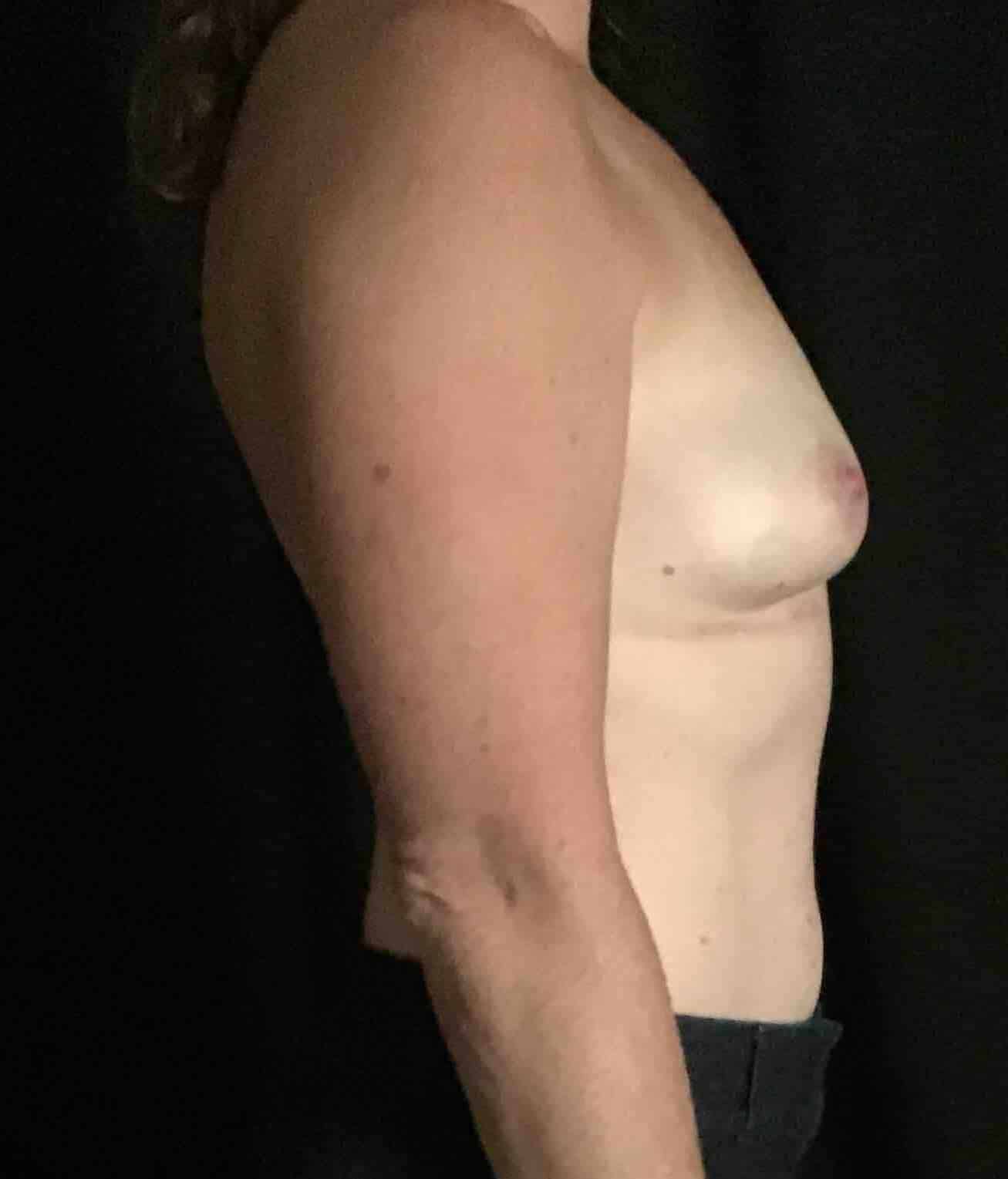 After Image: Bilateral En Bloc Capsulectomy with Breast Implant Removal; 2 months postoperative - right-side