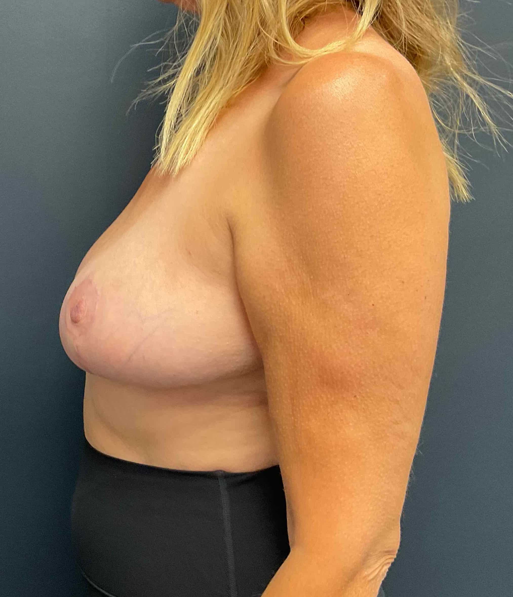 After Image: Cosmetic Breast Reduction; 4 months postoperative - left-side
