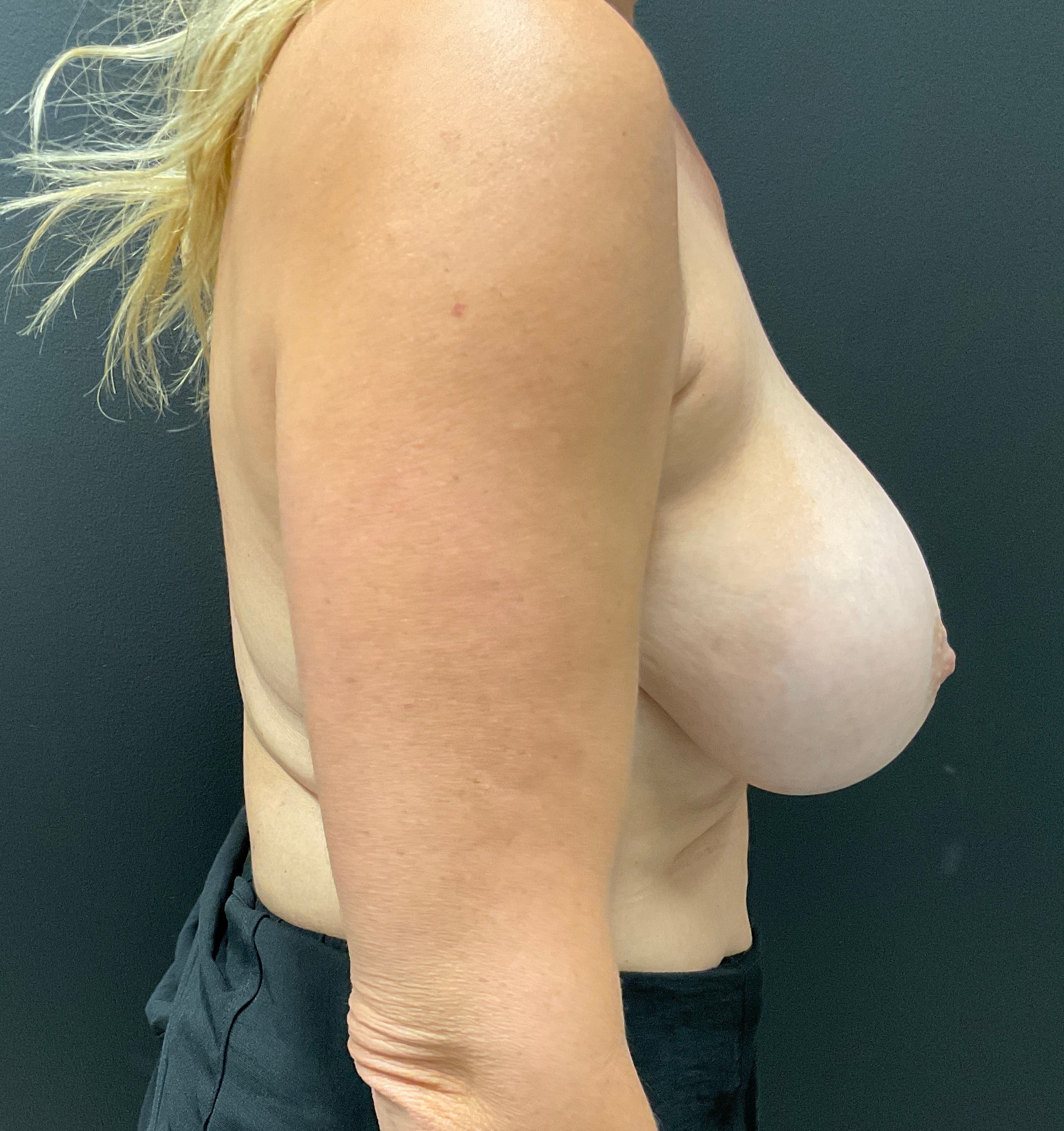 Before Image: Breast Implant Removal; Mastopexy (breast lift); 6 months postoperative - right-side
