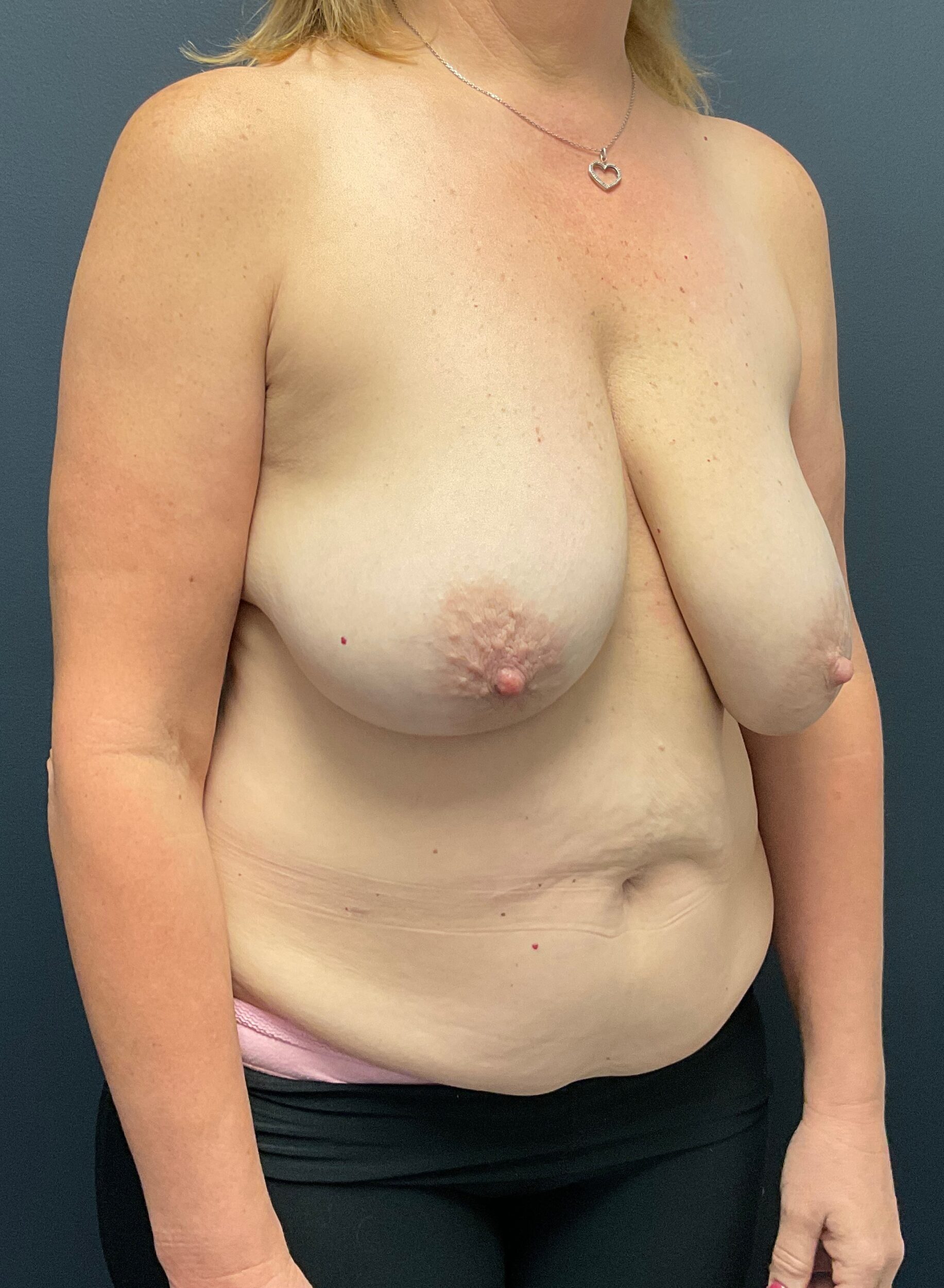 Before Image: Breast Reduction and Autologous Breast Reconstruction - right-front-oblique