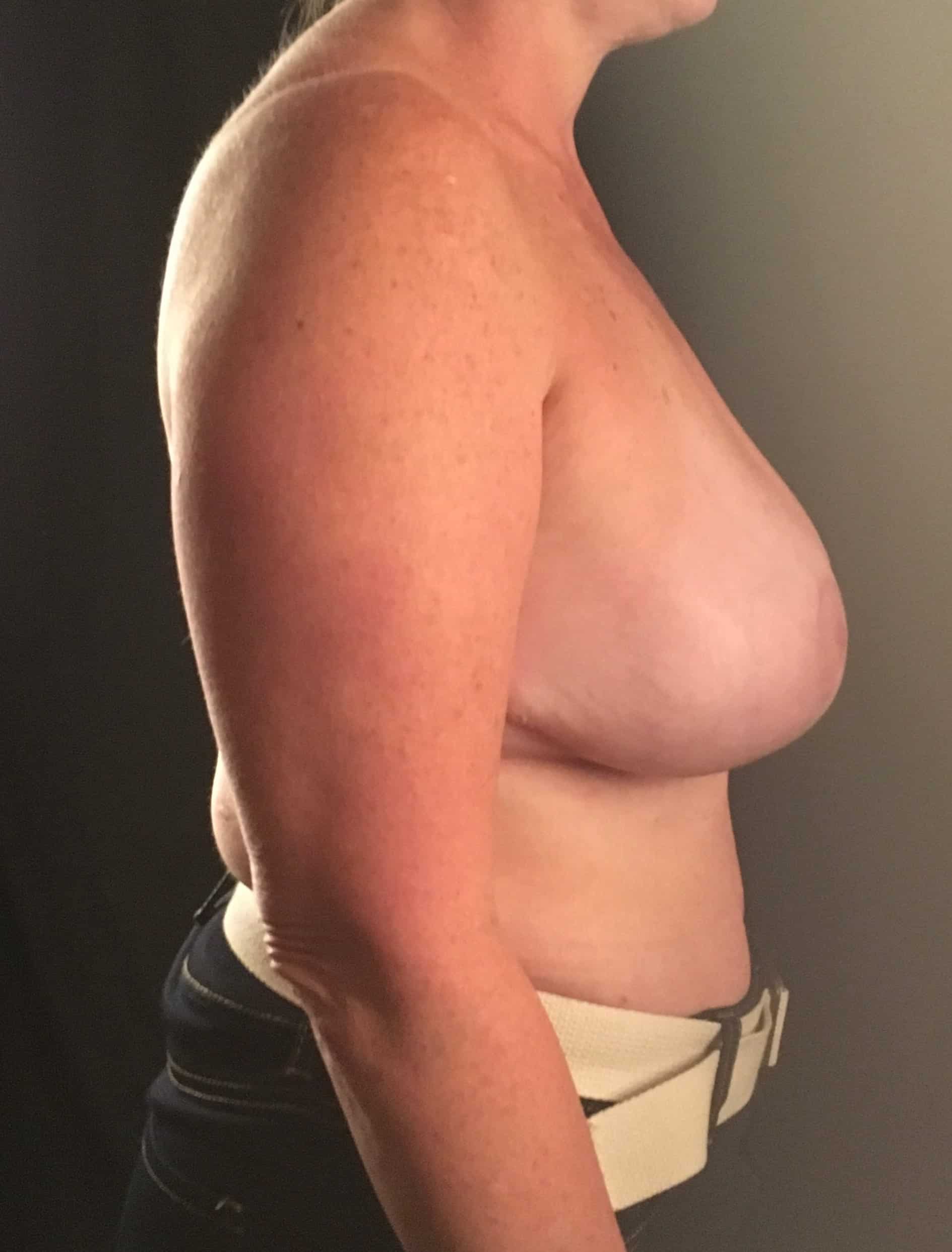After Image: Breast Implant Removal; Partial Capsulectomy; Mastopexy (breast lift); 3 months postoperative - right-side