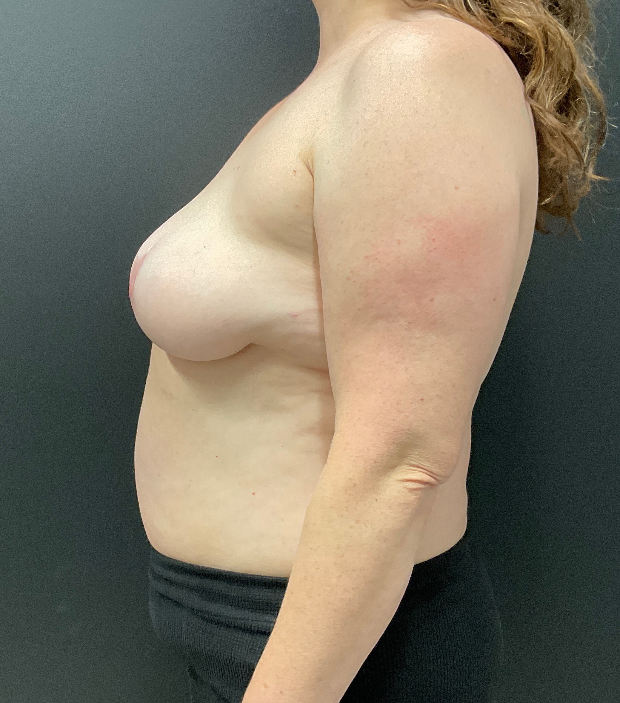 After Image: Bilateral En Bloc Capsulectomy with Breast Implant Removal; Mastopexy; 7 months postoperative - left-side