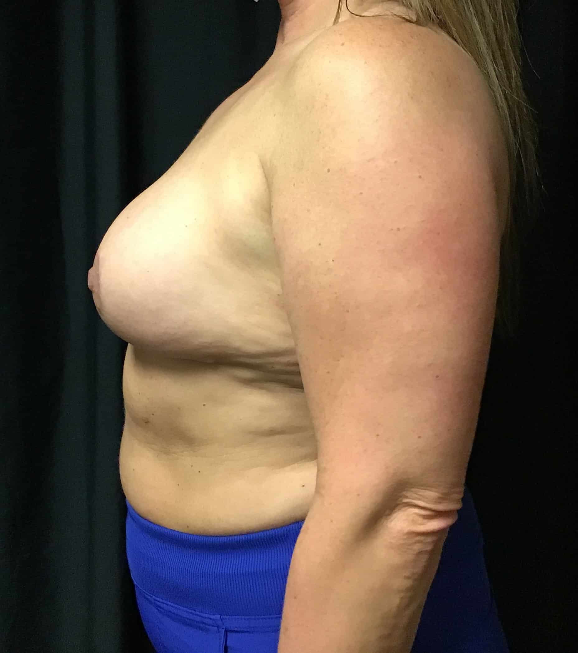 After Image: Cosmetic Breast Reduction; 3 months postoperative - left-side