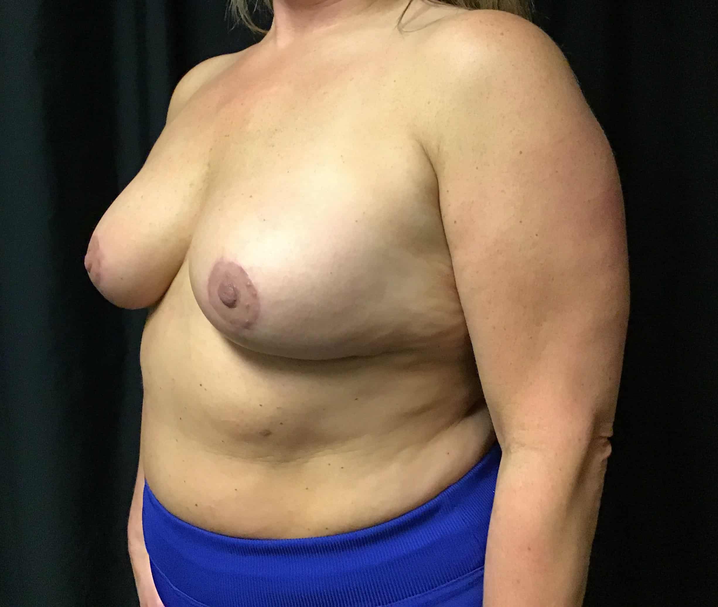 After Image: Cosmetic Breast Reduction; 3 months postoperative - left-front-oblique