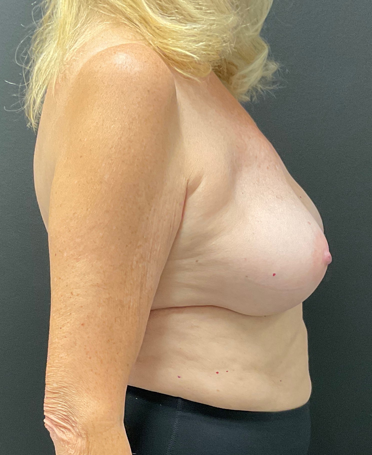After Image: Breast Implant Exchange - right-side