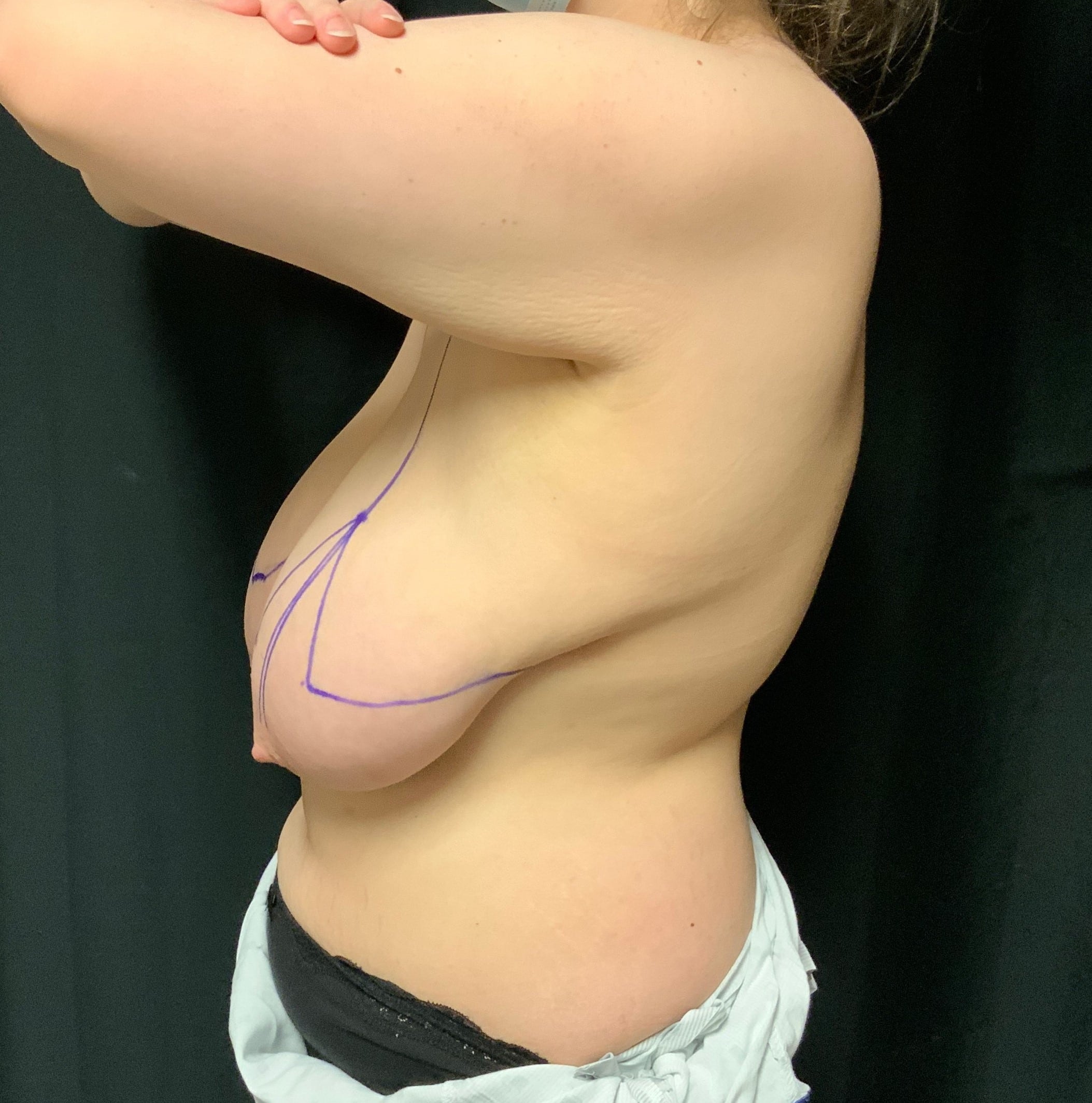 Before Image: Cosmetic Breast Reduction; 5 months postoperative - left-side