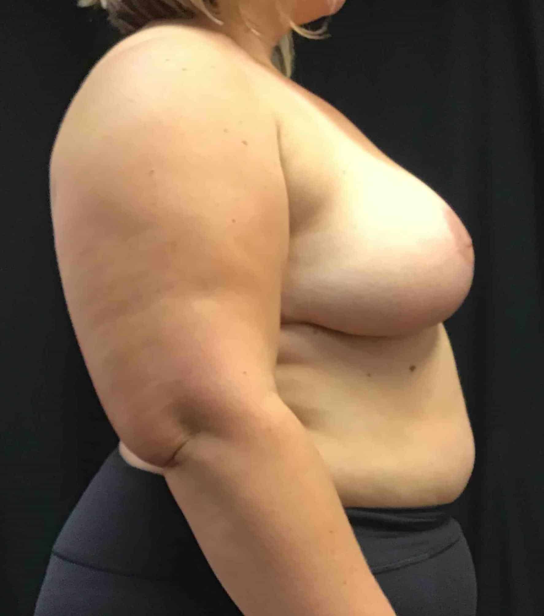 After Image: Cosmetic Breast Reduction; 6 months postoperative - right-side