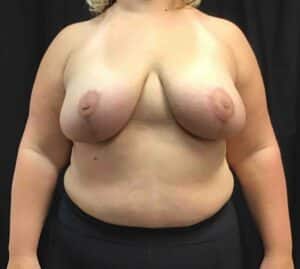Cosmetic Breast Reduction; 6 months postoperative