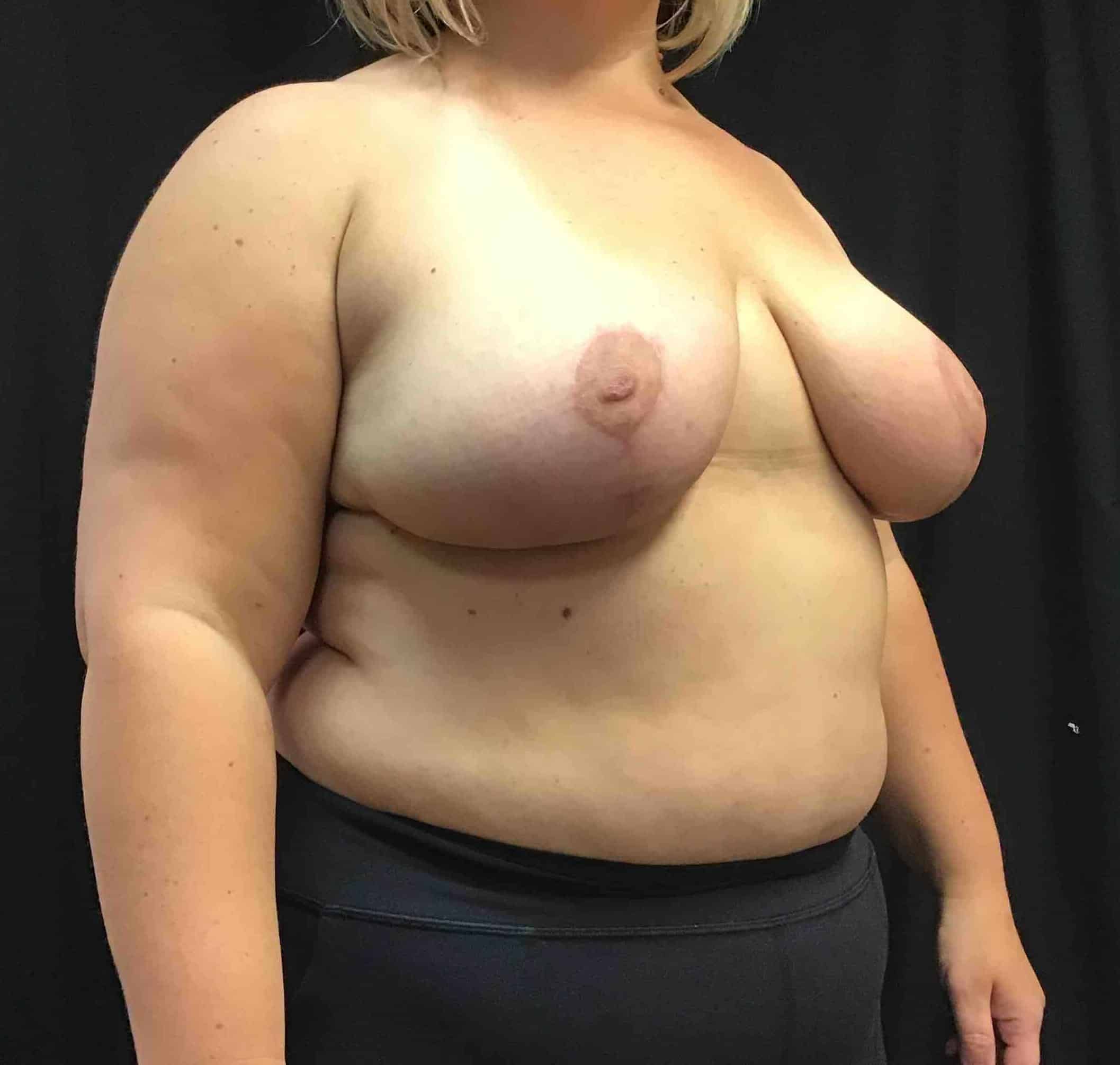 After Image: Cosmetic Breast Reduction; 6 months postoperative - right-front-oblique