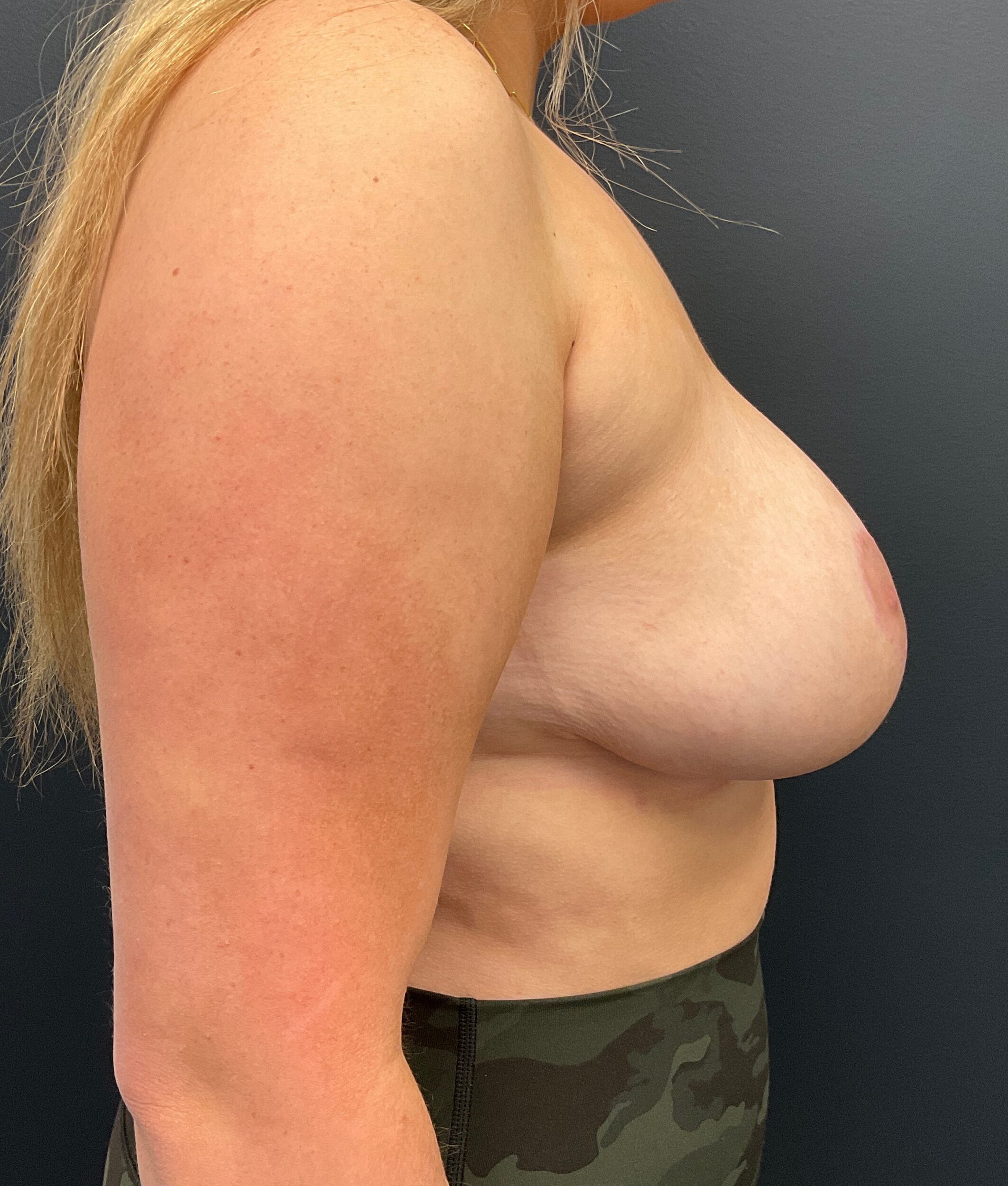After Image: Cosmetic Breast Reduction; 6 months postoperative - right-side