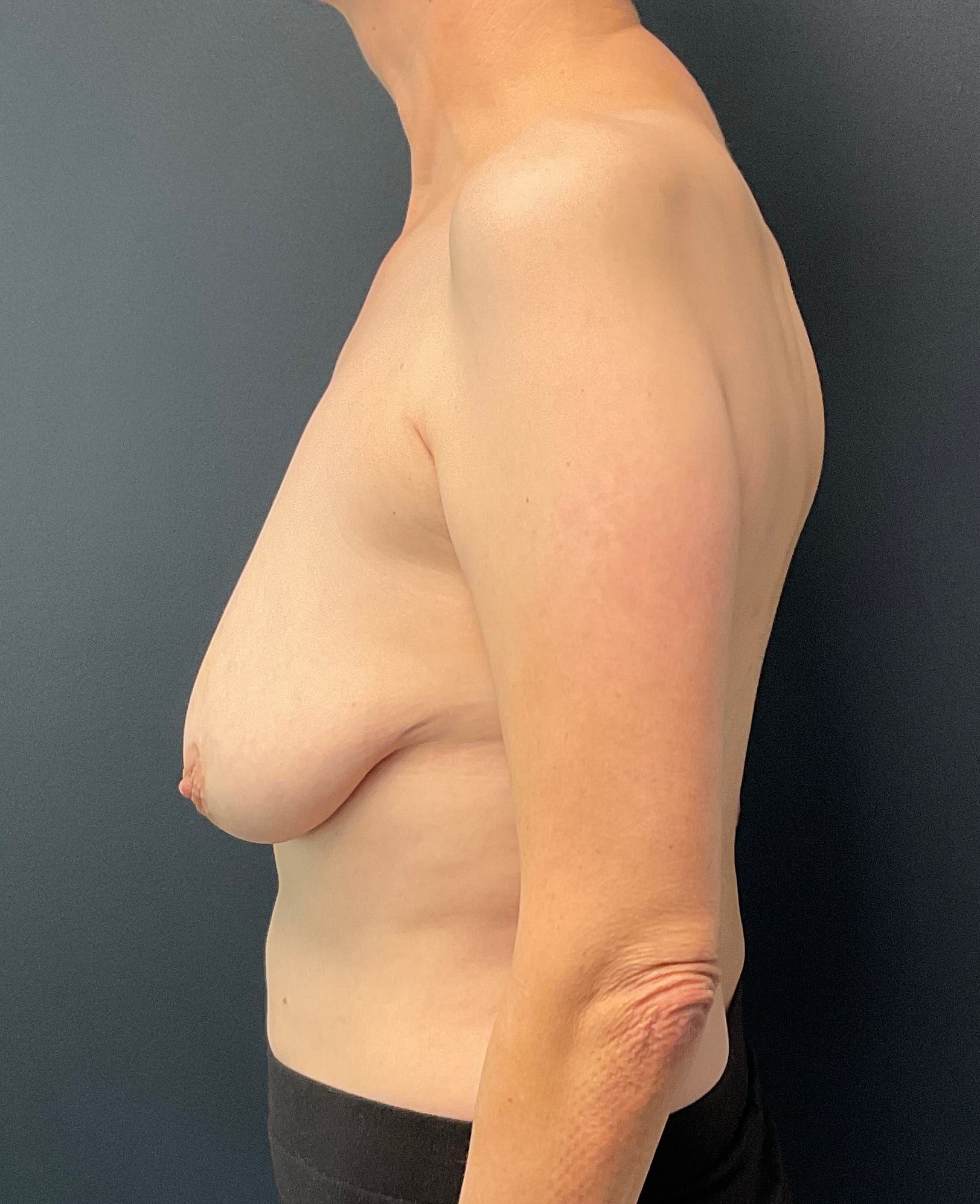Before Image: Breast Lift with 250cc Silicone Implants; 4 months postoperative - left-side