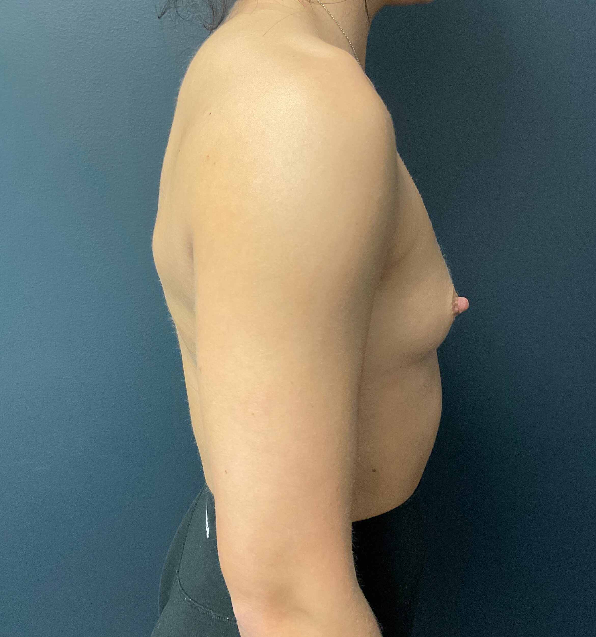 Before Image: Breast Augmentation; 275cc silicone implants - right-side