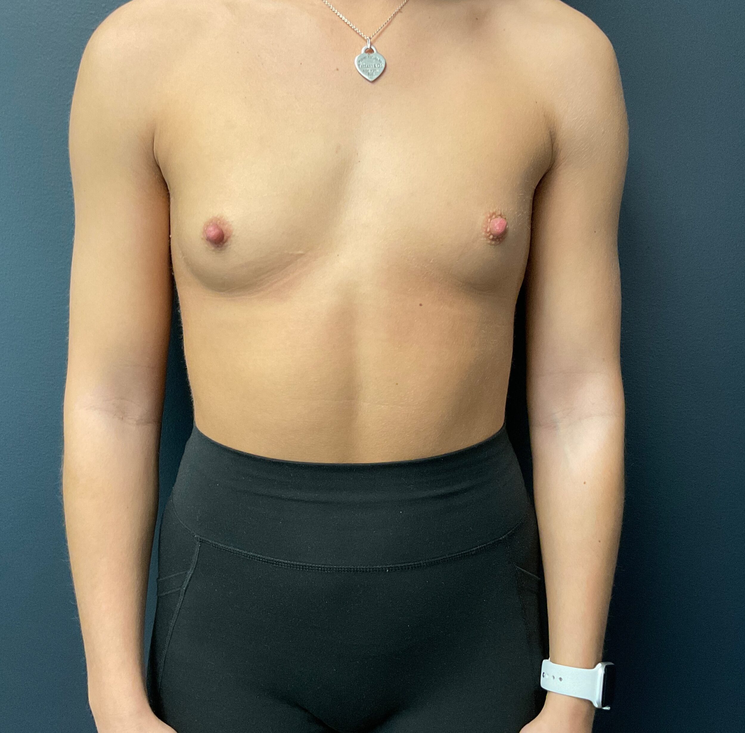 Before Image: Breast Augmentation; 275cc silicone implants - front