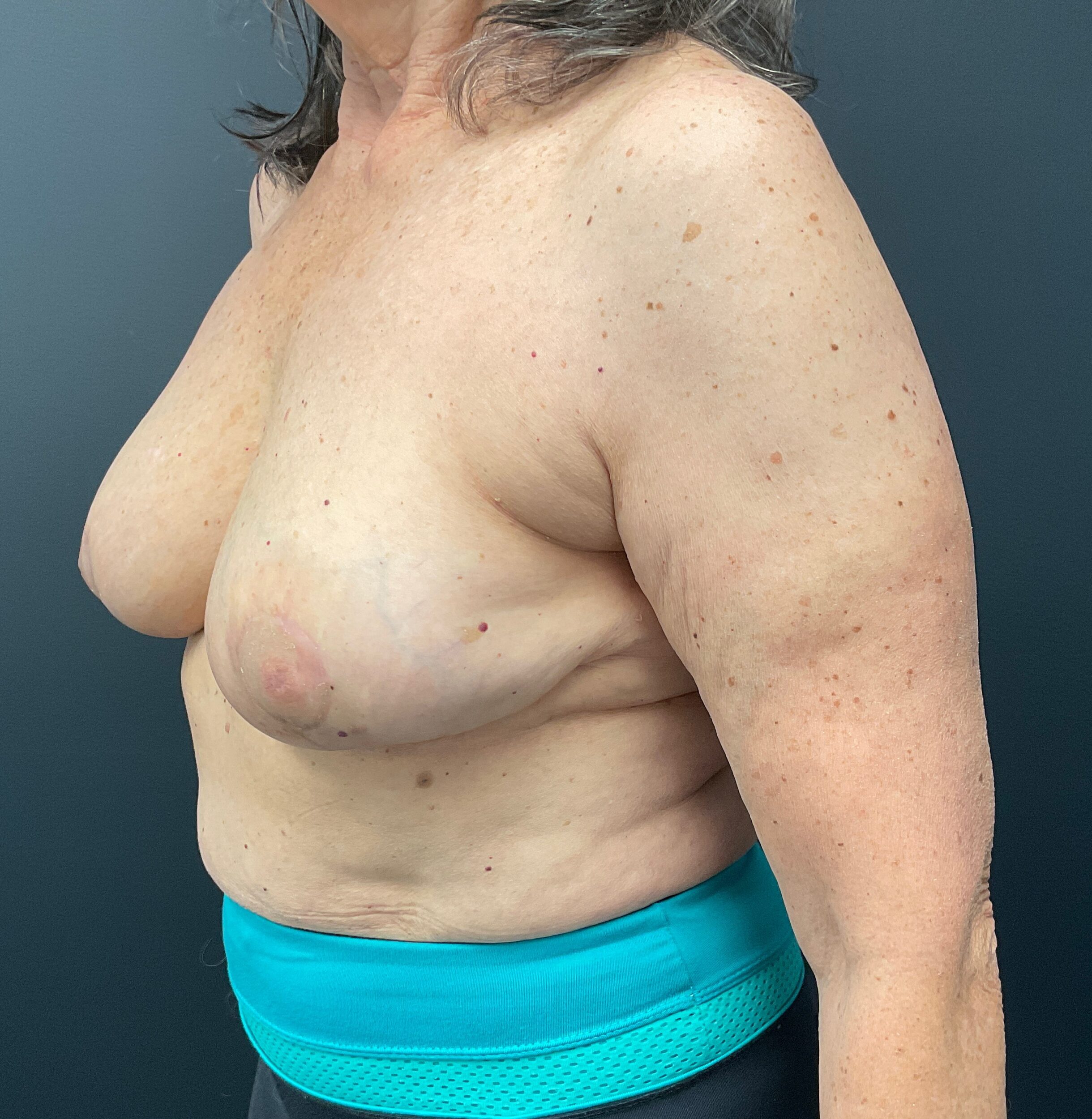 After Image: Cosmetic Breast Reduction; 4 months postoperative - left-front-oblique
