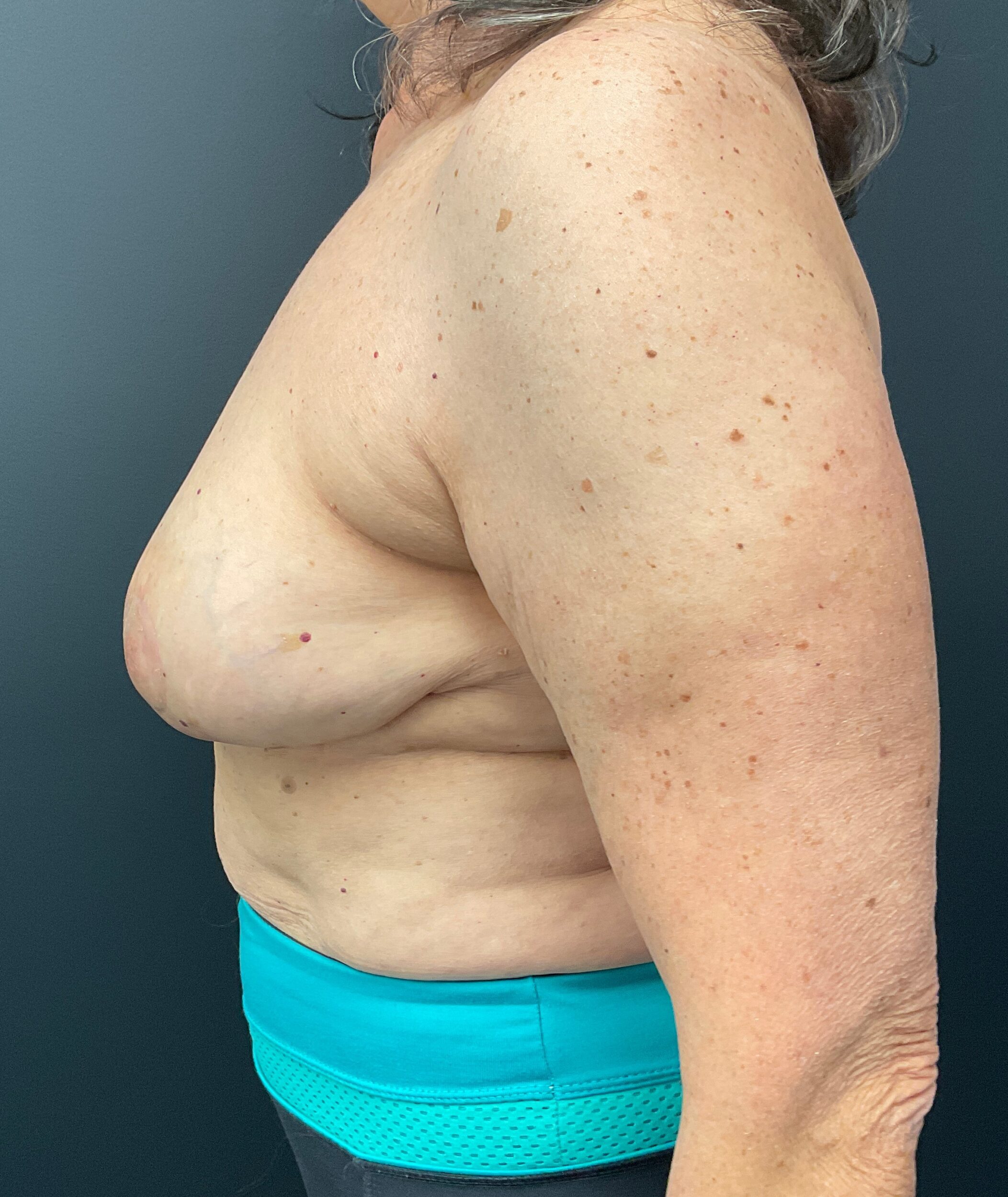 After Image: Cosmetic Breast Reduction; 4 months postoperative - left-side
