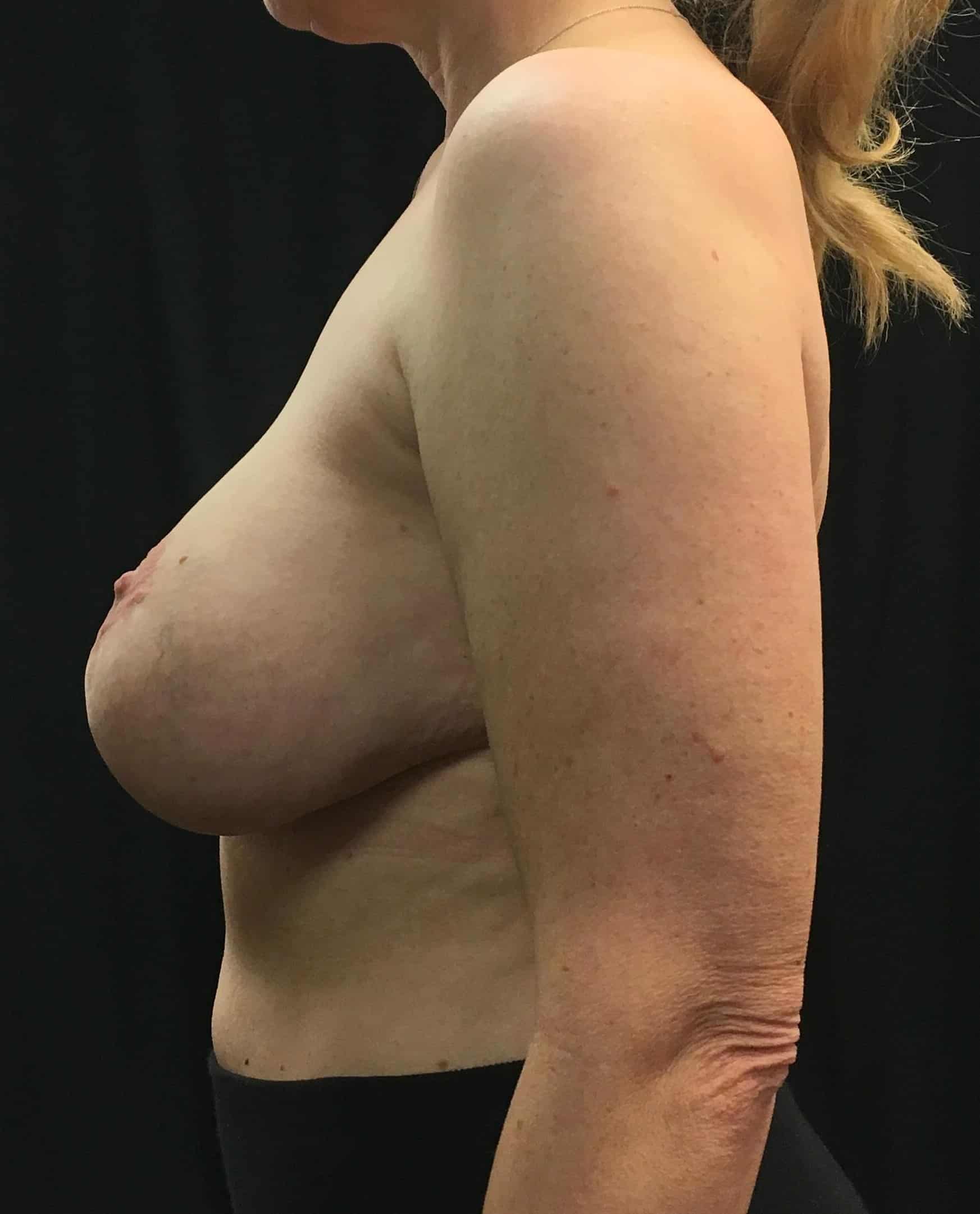 Before Image: Breast Implant Removal; Capsulectomy; Mastopexy; 9 months postoperative - other